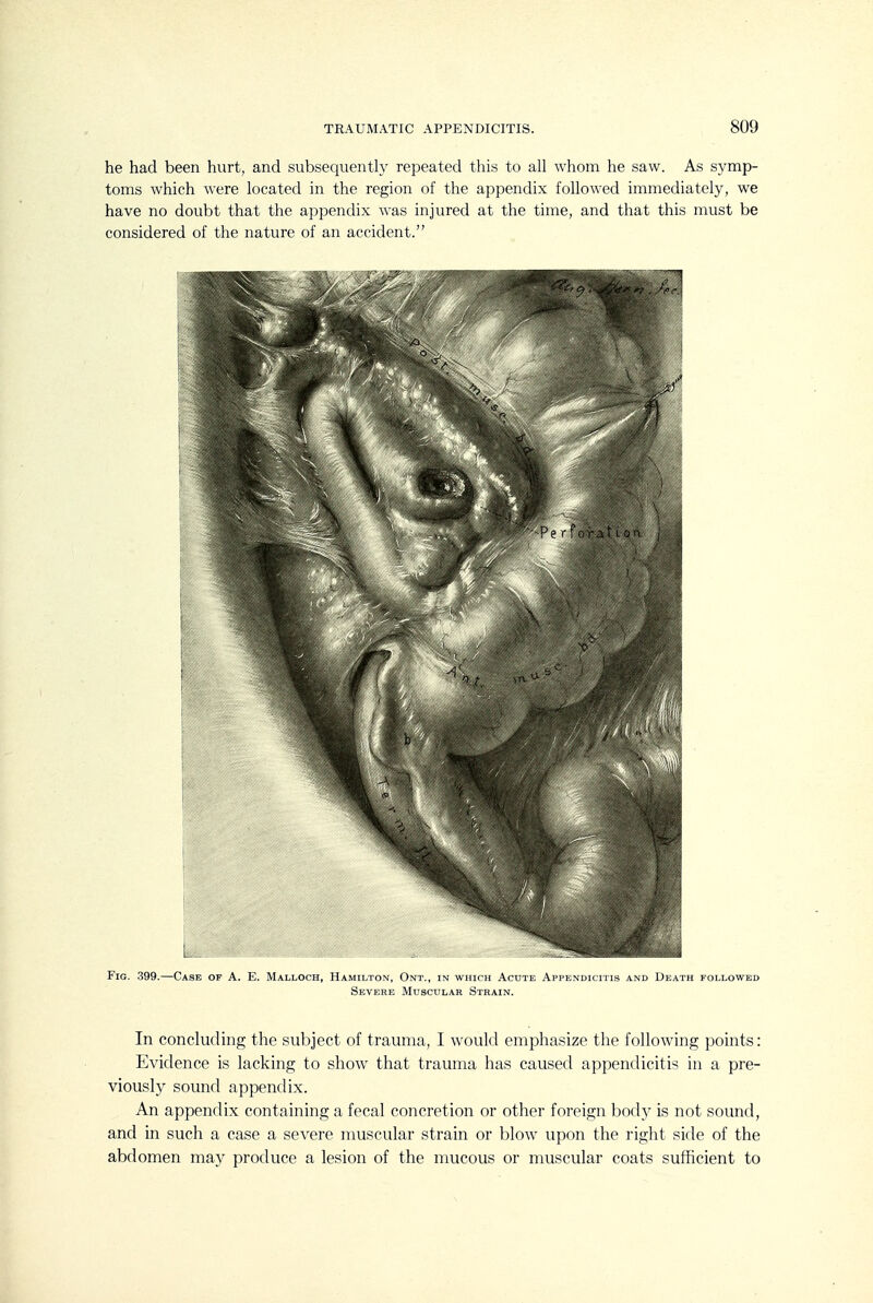 he had been hurt, and subsequently repeated this to all whom he saw. As symp- toms which were located in the region of the appendix followed immediately, we have no doubt that the appendix was injured at the time, and that this must be considered of the nature of an accident. Fig. 399.—Case of A. E. Malloch, Hamilton, Ont., in which Acute Appendicitis and Death followed Severe Muscular Strain. In concluding the subject of trauma, I would emphasize the following points: Evidence is lacking to show that trauma has caused appendicitis in a pre- viously sound appendix. An appendix containing a fecal concretion or other foreign bod}^ is not sound, and in such a case a severe muscular strain or blow upon the right side of the abdomen may produce a lesion of the mucous or muscular coats sufficient to