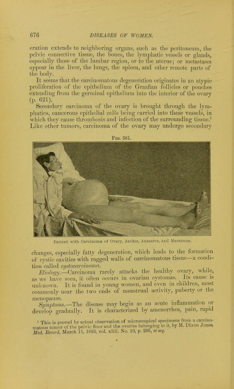 eration extends to neighboring organs, such as the peritoneum, the pelvic connective tissue, the bones, the lymphatic vessels or glands, especially those of the lumbar region, or to the uterus; or metastases appear in the liver, the lungs, the spleen, and other remote parts of the body. It seems that the carcinomatous degeneration originates in an atypic proliferation of the epithelium of the Graafian follicles or pouches extending from the germinal epithelium into the interior of the ovary (p. 621). Secondary carcinoma of the ovary is brought through the lym- phatics, cancerous epithelial cells being carried into these vessels, in which they cause thrombosis and infection of the surrounding tissue.1 Like other tumors, carcinoma of the ovary may undergo secondary Fig. 361. Patient with Carcinoma of Ovary, Ascites, Anasarca, and Marasmus. changes, especially fatty degeneration, which leads to the formation of cystic cavities with ragged walls of carcinomatous tissue—a condi- tion called eystocarcinoma. Etiology.—Carcinoma rarely attacks the healthy ovary, while, as we have seen, it often occurs in ovarian cystomas. Its cause is unknown. It is found in young women, and even in children, most commonly near the two ends of menstrual activity, puberty or the menopause. Symptoms— The disease may begin as an acute inflammation or develop gradually. It is characterized by amenorrhea, pain, rapid 1 This is proved by actual observation of microscopical specimens from a carcino- matous tumor of thepelvic floor and the ovaries belonging to it, by M. Dixon Jones, Med. Record, March 1 1, 1893, vol. xliii. JSfo. 10, p. 295, etseq.
