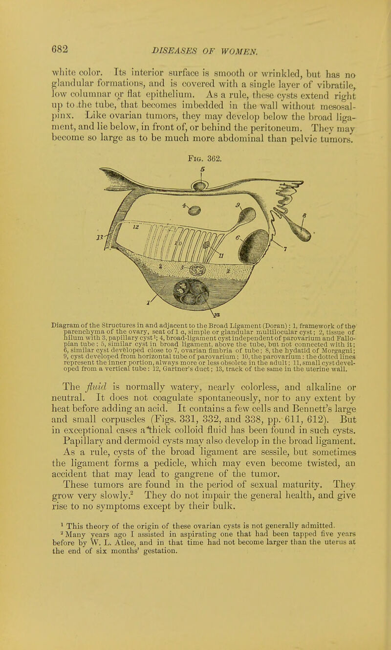white color. Its interior surface is smooth or wrinkled, but has no glandular formations, and is covered with a single layer of vibratile, low columnar or flat epithelium. As a rule, these cysts extend right up to the tube, that becomes imbedded in the wall without mesosal- pinx. Like ovarian tumors, they may develop below the broad liga- ment, and lie below, in front of, or behind the peritoneum. They may become so large as to be much more abdominal than pelvic tumors. Fig. 362. Diagram of the Structures in and adjacent to the Broad Ligament (Doran): 1, framework of the parenchyma of the ovary, seat of 1 a, simple or glandular multilocular cyst; 2, tissue of hilum with 3, papillary cystl; 4, broad-ligament cyst independent of parovarium and Fallo- pian tube ; 5, similar cyst in broad ligament, above the tube, but not connected with it; 6, similar cyst developed close to 7, ovarian fimbria of tube; 8, ihe hydatid of Morgagni; 9, cyst developed from horizontal tube of parovarium; 10, the parovarium: the dotted lines represent the inner portion, always more or less obsolete in the adult; 11, small cyst devel- oped from a vertical tube: 12, Gartner's duct; 13, track of the same in the uterine waU. The fluid is normally watery, nearly colorless, and alkaline or neutral. It does not coagulate spontaneously, nor to any extent by heat before adding an acid. It contains a few cells and Bennett's large and small corpuscles (Figs. 331, 332, and 338, pp. 611, 612). But in exceptional cases a*thick colloid fluid has been found in such cysts. Papillary and dermoid cysts may also develop in the broad ligament. As a rule, cysts of the broad ligament are sessile, but sometimes the ligament forms a pedicle, which may even become twisted, an accident that may lead to gangrene of the tumor. These tumors are found in the period of sexual maturity. They grow very slowly.2 They do not impair the general health, and give rise to no symptoms except by their bulk. 1 This theory of the origin of these ovarian cysts is not generally admitted. 2 Many years ago I assisted in aspirating one that had been tapped five years before by W. L. Atlee, and in that time had not become larger than the uterus at the end of six months' gestation.