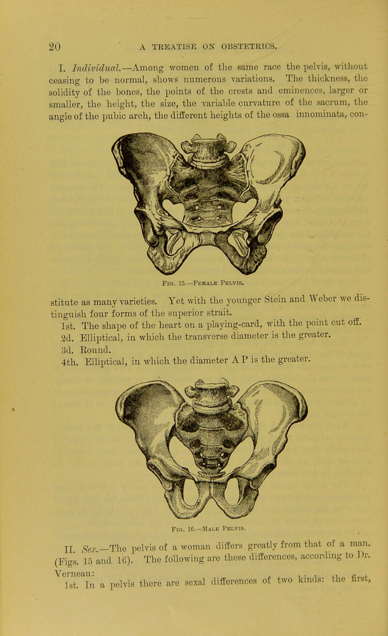 I. Individual.—Among women of the same race the pelvis, without ceasing to be normal, shows numerous variations. The thickness, the solidity of the bones, the points of the crests and eminences, larger or smaller, the height, the size, the variable curvature of the sacrum, the angle of the pubic arch, the different heights of the ossa innominata, con- FiG. 15.—Female Pelvis. stitute as many varieties. Yet with the younger Stein and Weber we dis- tinguish four forms of the superior strait. 1st. The shape of the heart on a playing-card, with the point cut ofE. 2d. Elliptical, in which the transverse diameter is the greater. 3d. Round. 4th. Elliptical, in which the diameter A P is the greater. Fio. 16.—Male Pelvis. II Sex.—'niG pelvis of a woman dilfers greatly from that of a man. (Figs. 15 and IC). The following arc these differences, according to Dr. ^^IsTTn a pelvis there are sexal differences of two kinds: the first.