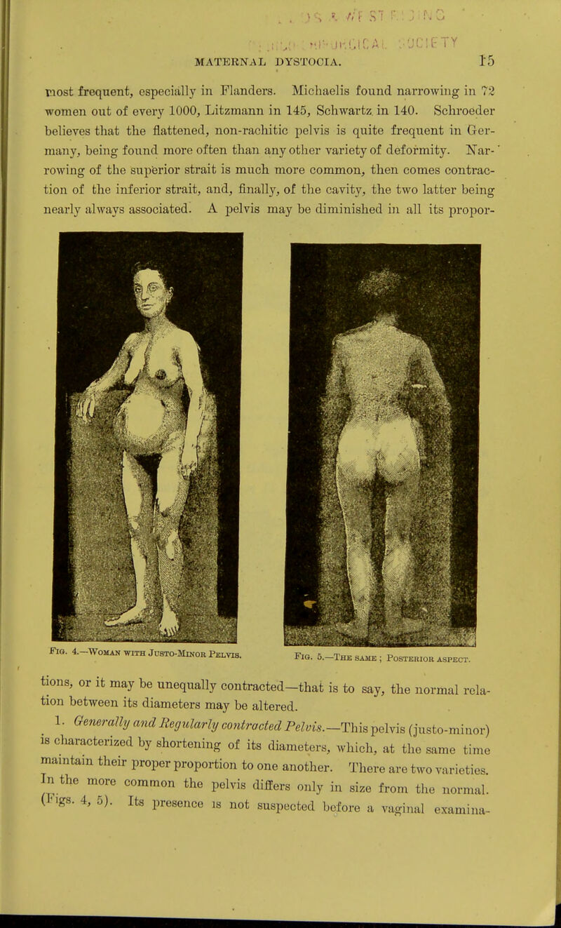 tiost frequent, especially in Flanders. Micliaelis found narrowing in 72 women out of every 1000, Litzmann in 145, Schwartz, in 140. Scliroeder believes that the flattened, non-rachitic pelvis is quite frequent in Ger- many, being found more often than any other variety of defoi-mity. Kar-' rowing of the superior strait is much more common, then comes contrac- tion of the inferior strait, and, finally, of the cavity, the two latter being nearly always associated. A pelvis may be diminished in all its propor- Fio. 4.—Woman WITH JusTo-MiNOR Pelvis. l it.. J.—iili^ sAilK , i'oiiTEIUOK AbPECr. tions, or it may be unequally contracted-that is to say, the normal rela- tion between its diameters may be altered. 1. Generally and Regularly contracted Pelvis.-This pelvis (justo-minor) IS characterized by shortening of its diameters, which, at the same time mamtam their proper proportion to one another. There are two varieties. In the more common the pelvis differs only in size from the normal. (iMgs. 4, 5). Its presence is not suspected before a vaginal examina-