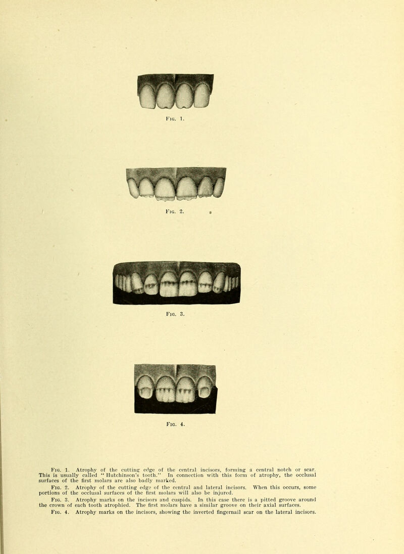 f I'lG. 2. t Fig. 3. Fig. 4. Fig. 1. Atrophy of the cutting eO.ge of the central incisors, forming a central notch or scar. This is usually called  Hutchinson's tooth. In connection with this form of atrophy, the occlusal surfaces of the first molars are also badly marked. Fig. 2. Atrophy of the cutting edge of the central and lateral incisors. When this occurs, some portions of the occlusal surfaces of the first molars will also be injured. Fig. 3. Atrophy marlis on the incisors and cuspids. In this case there is a pitted groove around the crown of each tooth atrophied. The first molars have a similar groove on tlieir axial surfaces.