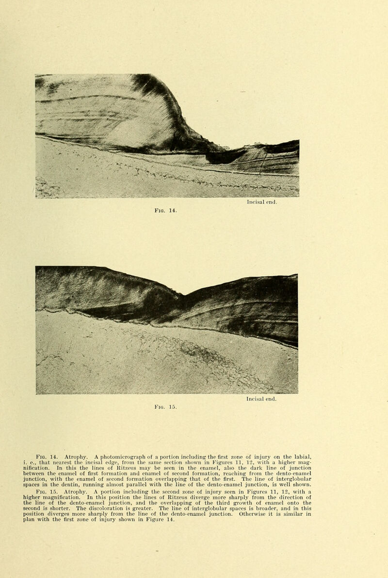 In. isiil ,;ul VlG. 15. Fig. 14. Atrophy. A photomicrograph of a portion including the first zone of injury on the labial, i. e., that nearest the incisal edge, from the same section sliown in Figures 11, 12, witli a higher mag- nification. In this the lines of Kitzeus may be seen in the enamel, also the dark line of junction between the enamel of first formation and enamel of second formation, reaching from the dento-enamel junction, with the enamel of second formation overlapping that of the first. The line of interglobular spaces in the dentin, running almost parallel with the line of the dento-enamel junction, is well shown. Fig. 15. Atrophy. A portion including the second zone of injury seen in Figures 11, 12, with a higher magnification. In this position the lines of Ritzeus diverge more sharply from the direction of the line of the dento-enamel junction, and the overlapping of the third growth of enamel onto the second is shorter. The discoloration is greater. The line of interglobular spaces is broader, and in this position diverges more shai^ply from the line of the dento-enamel junction. Otherwise it is similar in plan with the first zone of injury shown in Figure 14.