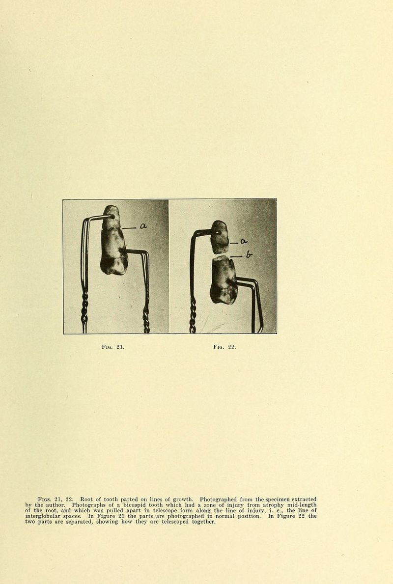 Figs. 21, 22. Root o£ tooth parted on lines of growth. Photographed from the specimen extracted by the author. Photographs of a bicuspid tooth which had a zone of injury from atrophy mid-length of the root, and which was pulled apart in telescope form along the line of injury, i. e., the line of interglobular spaces. In Figure 21 the parts are photographed in normal position. In Figure 22 the two parts are separated, showing how they are telescoped together.