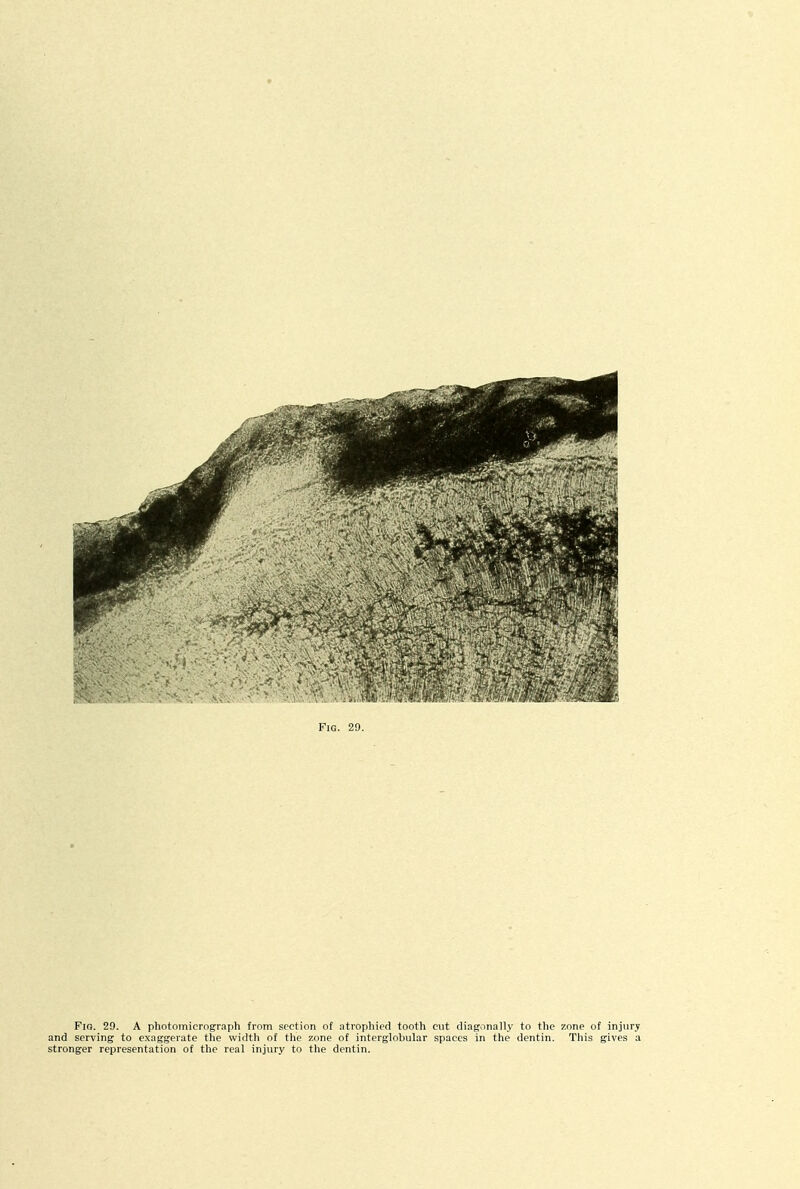 Fig. 29. A photomicrograph from section of ntrophied tooth cut diagonally to the zone of injury and serving to exaggerate the width of the zone of interglobular spaces in the dentin. This gives a stronger representation of the real injury to the dentin.