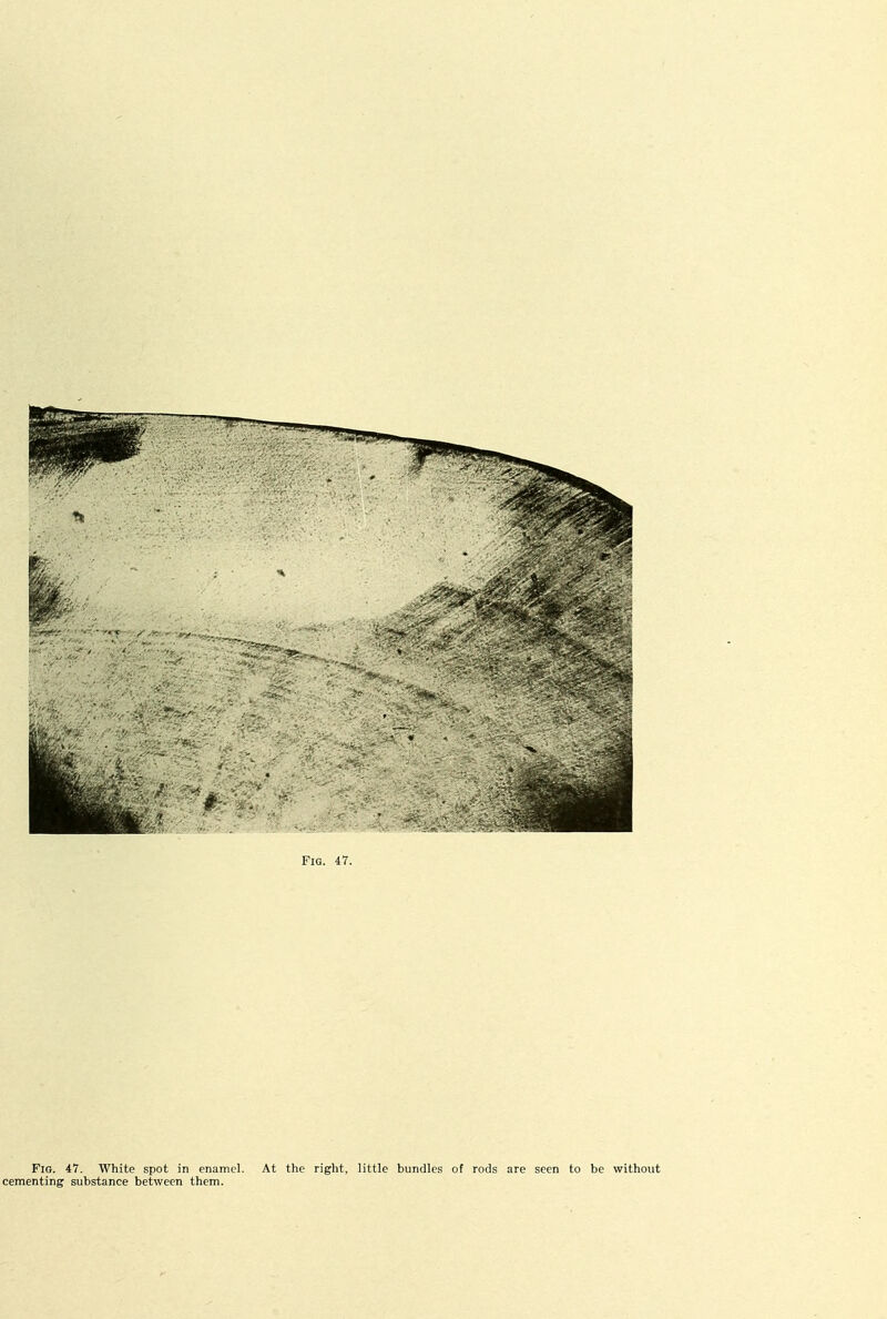 Fig. 47. White spot in enamel. At the right, little bundles of rods are seen to be without cementing substance between them.