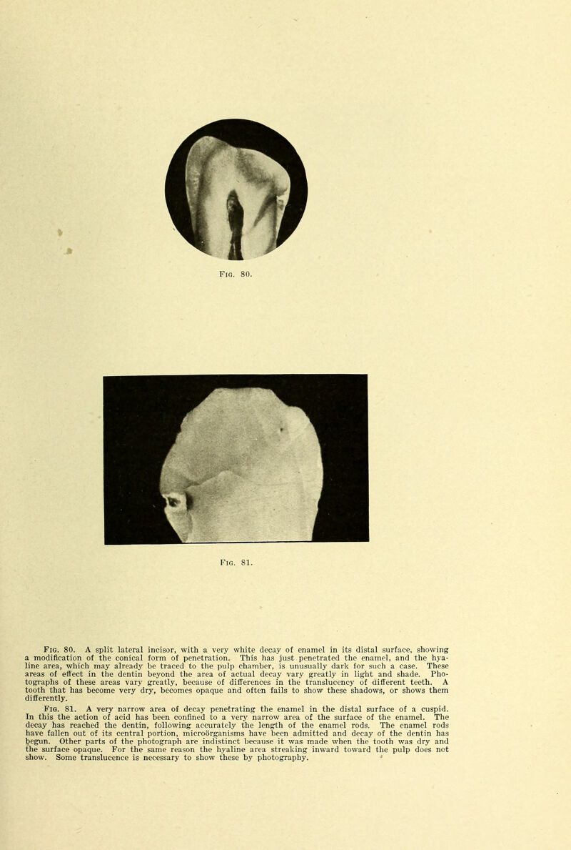 Fig. 80. A split lateral incisor, with a very white decay of enamel in its distal surface, showing a modification of the conical form of penetration. This has just penetrated the enamel, and the hya- line area, which may already be traced to the pulp chamber, is unusually dark for such a case. These areas of effect in the dentin beyond the area of actual decay vary greatly in light and shade. Pho- tographs of these areas vary greatly, because of differences in the translucency of different teeth. A tooth that has become very dry, becomes opaque and often fails to show these shadows, or shows them differently. F:g. 81. A very narrow area of decay penetrating the enamel in the distal surface of a cuspid. In this the action of acid has been confined to a very narrow area of the surface of the enamel. The decay has reached the dentin, following accurately the length of the enamel rods. The enamel rods have fallen out of its central portion, microorganisms have been admitted and decay of the dentin has begun. Other parts of the photograph are indistinct because it was made when the tooth was dry and the surface opaque. For the same reason the hyaline area streaking inward toward the pulp does not show. Some translucence is necessary to show these by photography. -