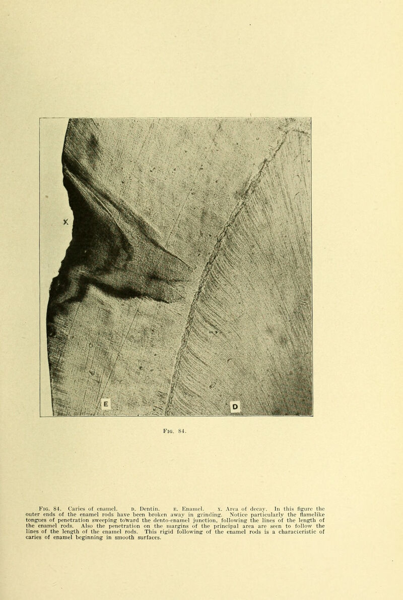 Fig. 84. C'ai'ies of enamel. n. Drntin. E. Enamel. x. Area of decay. In tliis figure the outer ends of the enamel rods have been broken away in grinding. Notice particularly the flamelike tongues of penetration sweeping toWard the dento-enamel junction, following the lines of the length of the enamel rods. Also the penetration on the margins of the principal area are seen to follow the lines of the length of the enamel rods. This rigid following of the enamel rods is a characteristic of caries of enamel beginning in smooth surfaces.