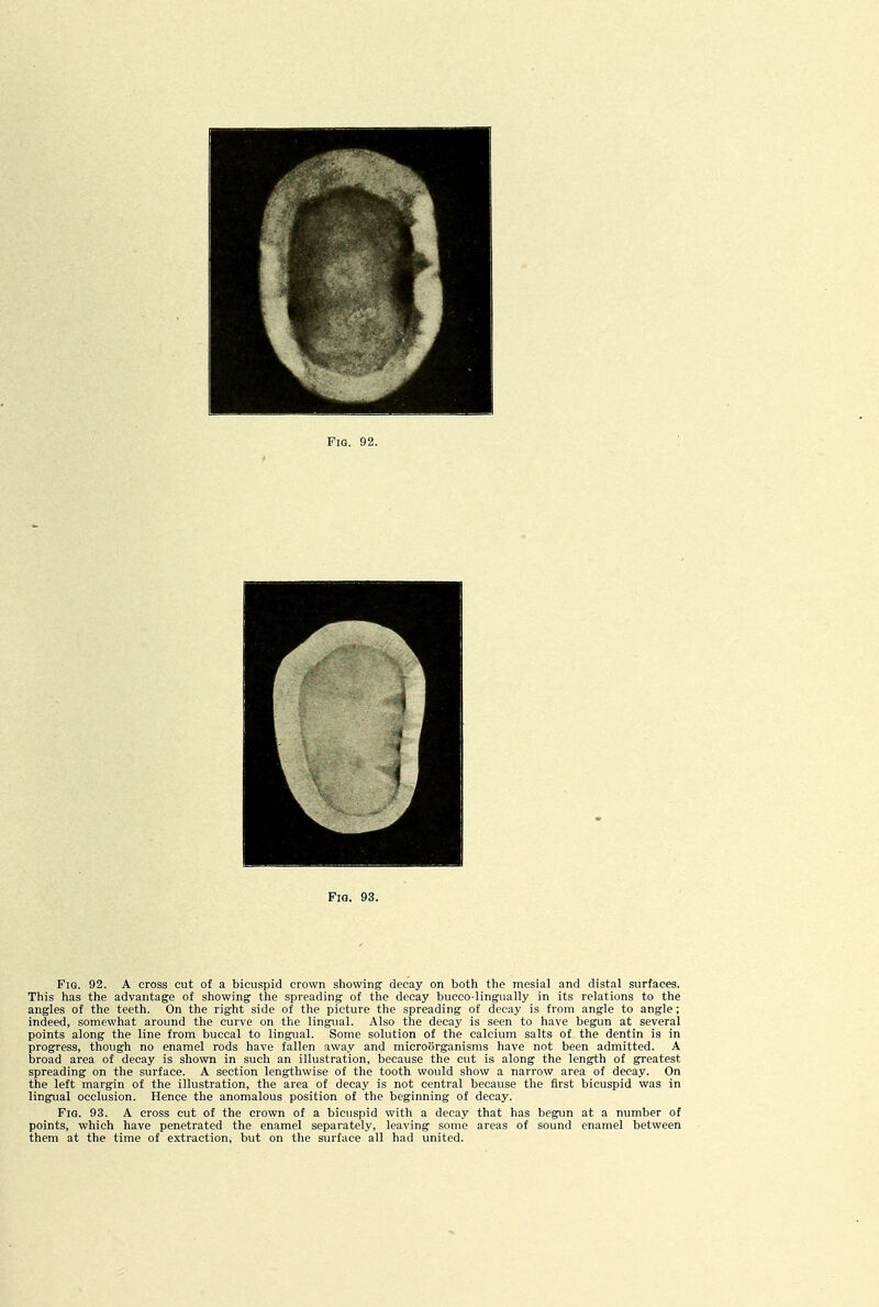 FiQ. 93. Fig. 92. A cross cut of a bicuspid crown showing decay on both the mesial and distal surfaces. This has the advantage of showing the spreading of the decay bucco-lingually in its relations to the angles of the teeth. On the right side of the picture the spreading of decay is from angle to angle; indeed, somewhat around the curve on the lingual. Also the decay is seen to have begun at several points along the line from buccal to lingual. Some solution of the calcium salts of the dentin is in progress, though no enamel rods have fallen awa.v and microorganisms have not been admitted. A broad area of decay is shown in such an illustration, because the cut is along the length of greatest spreading on the surface. A section lengthwise of the tooth would show a narrow area of decay. On the left margin of the illustration, the area of decay is not central because the first bicuspid was in lingual occlusion. Hence the anomalous position of the beginning of decay. Fig. 93. A cross cut of the crown of a bicuspid with a decay that has begun at a number of points, which have penetrated the enamel separately, leaving some areas of sound enamel between them at the time of extraction, but on the surface all had united.