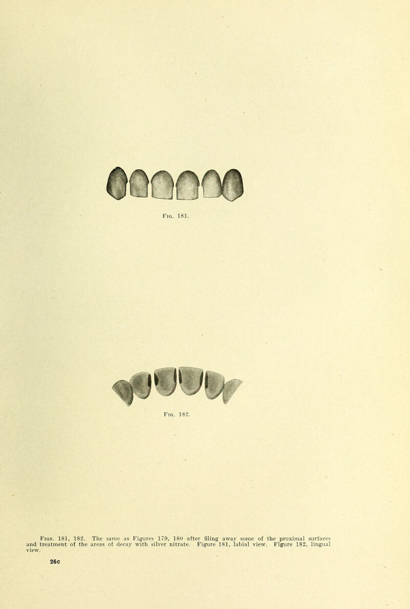 IMF J y' Fig. 1S2. Figs. ISl, 182. The same as Figures 179, ISO after filing away some of the proximal surfaces and treatment of the areas of decay with silver nitrate. Figure 181, labial view. Figure 182, lingual view. 26C