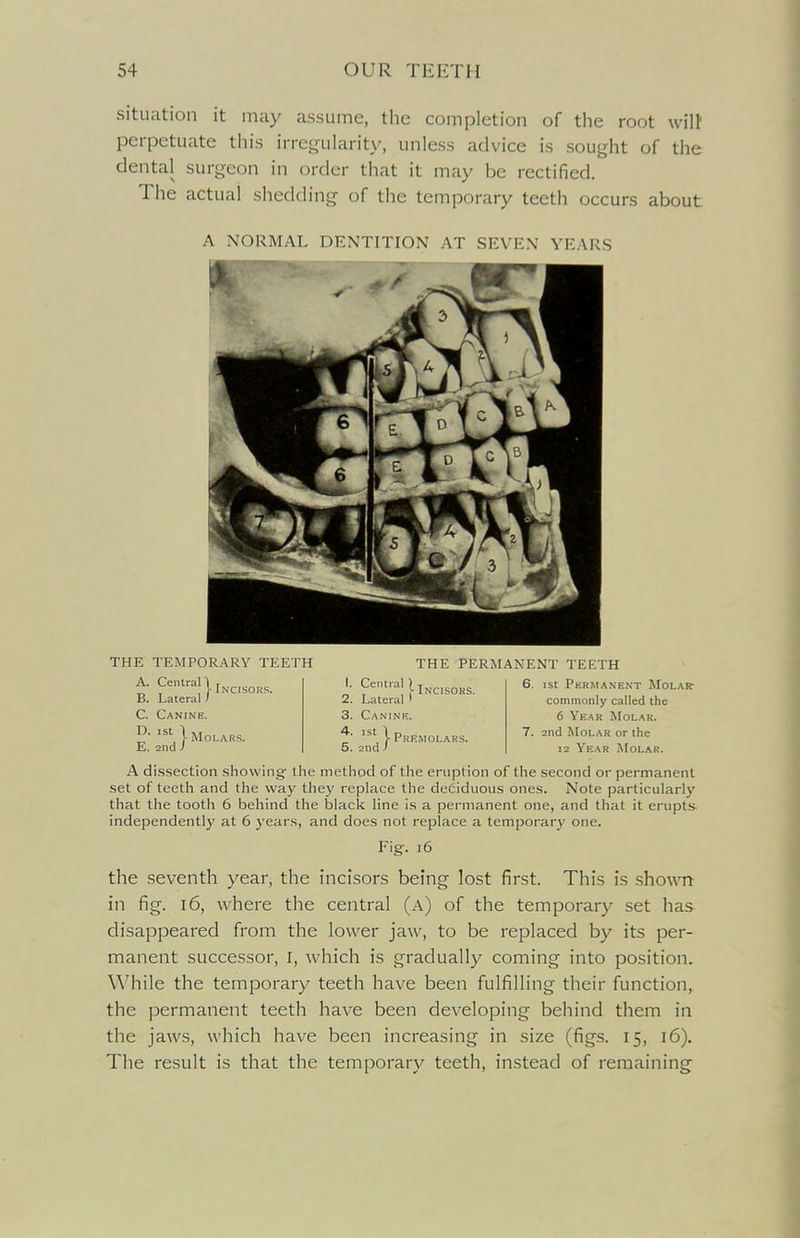 situation it may assume, the completion of the root will' perpetuate this irregularity, unless advice is sought of the dental surgeon in order that it may be rectified. The actual shedding of the temporary teeth occurs about A NORMAL DENTITION AT SEVEN YEARS THE TEMPORARY TEETH A. Central! „ , , )• Incisors. B. Lateral) C. Canine. D. ist ~ E. 2nd J ■ Molars. THE PERMANENT TEETH I. Central ^ji^^jg^j^g | 6. ist Permanent Molar- 2. Lateral I 3. Canine. 4. ist 5. 2nd Premolars. commonly called the 6 Year Molar. 7. 2nd Molar or the 12 Year Molar. A dissection showing the method of the eruption of the second or permanent set of teeth and the way they replace the deciduous ones. Note particularly that the tooth 6 behind the black line is a permanent one, and that it erupts- independently at 6 years, and does not replace a temporary' one. Fig;. 16 the seventh year, the incisors being lost first. This is showr^ in fig. 16, where the central (a) of the temporary set has disappeared from the lower jaw, to be replaced by its per- manent successor, I, which is gradually coming into position. While the temporary teeth have been fulfilling their function, the permanent teeth have been developing behind them in the jaws, which have been increasing in size (figs. 15, 16). The result is that the temporary teeth, instead of remaining