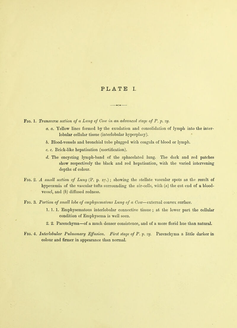 Fig. 1. Transverse section of a Lung of Cow in an advanced stage of P. p. zy. a. a. Yellow lines formed by the exudation and consolidation of lymph into the inter- lobular cellular tissue (interlobular hyperplasy). b. Blood-vessels and bronchial tube plugged with coagula of blood or lymph. c. c. Brick-like hepatisation (mortification). d. The encysting lymph-band of the sphacelated lung. The dark and red patches show respectively the black and red hepatisation, with the varied intervening depths of colour. Fig. 2. A small section of Lung (P. p. zy.); showing the stellate vascular spots as the result of hypersemia of the vascular tufts surrounding the air-cells, with (a) the cut end of a blood- vessel, and (6) diffused redness. Fig. 3. Portion of small lobe of emphysematous Lung of a Cow—external convex surface. 1. 1. 1. Emphysematous interlobular connective tissue ; at the lower part the cellular condition of Emphysema is well seen. 2. 2. Parenchyma—of a much denser consistence, and of a more florid hue than natural. Fig. 4. Interlobular Pulmonary Effusion. First stage of P. p. zy. Parenchyma a little darker in colour and firmer in appearance than normal.
