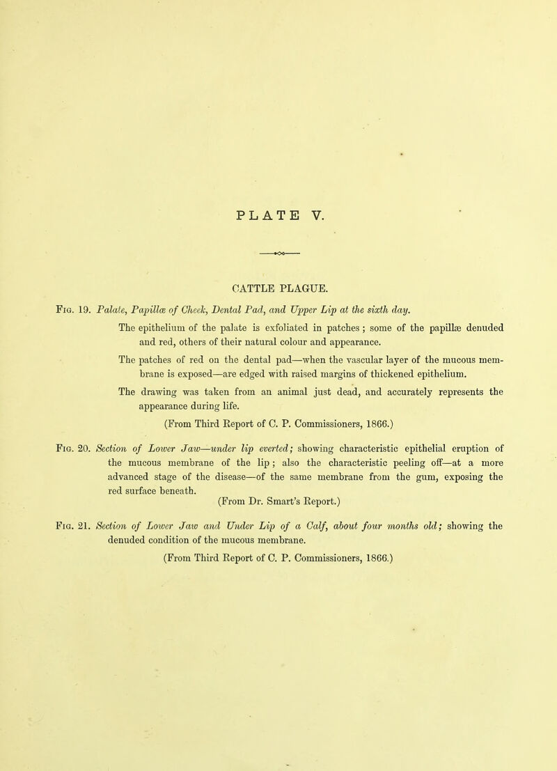 CATTLE PLAGUE. Fig. 19. Palate, Papilla of Check, Dental Pad, and Upper Lip at the sixth day. The epithelium of the palate is exfoliated in patches; some of the papillae denuded and red, others of their natural colour and appearance. The patches of red on the dental pad—when the vascular layer of the mucous mem- brane is exposed—are edged with raised margins of thickened epithelium. The drawing was taken from an animal just dead, and accurately represents the appearance during life. (From Third Report of C. P. Commissioners, 1866.) Fig. 20. Section of Lower Jaw—under lip everted; showing characteristic epithelial eruption of the mucous membrane of the lip; also the characteristic peeling off—at a more advanced stage of the disease—of the same membrane from the gum, exposing the red surface beneath. (From Dr. Smart's Report.) Fig. 21. Section of Lower Jaw and Under Lip of a Calf, about four months old; showing the denuded condition of the mucous membrane.