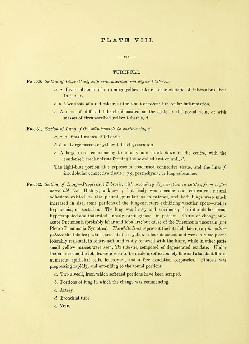 TUBERCLE. Fig. 30. Section of Liver (Cow), vnth circumscribed and diffused tubercle. a. a. Liver substance of an orange-yellow colour,—characteristic of tuberculous liver in the ox. b. b. Two spots of a red colour, as the result of recent tubercular inflammation. c. A mass of diffused tubercle deposited on the coats of the portal vein, e: with masses of circumscribed yellow tubercle, d. Fig. 31. Section of Lung of Ox, with tubercle in various stages. a. a. a. Small masses of tubercle. b. b. b. Large masses of yellow tubercle, caseation. c. A large mass commencing to liquefy and break down in the centre, with the condensed areolar tissue forming the so-called cyst or wall, d. The light-blue portion at e represents condensed connective tissue, and the lines /, interlobular connective tissue ; g g, parenchyma, or lung-substance. Fig. 32. Section of Lung—Progressive Fibrosis, ivith secondary degeneration in patches, from a five years' old Ox.—History, unknown; but body was anijemic and emaciated, pleural adhesions existed, as also pleural granulations in patches, and both lungs were much increased in size, some portions of the lung-structure exhibiting vascular spots—stellar hyperemia, on sectation. The lung was heavy and scirrhous ; the interlobular tissue hypertrophied and indurated—nearly cartilaginous—in patches. Cause of change, sub- acute Pneumonia (probably lobar and lobular); but cause of the Pneumonia uncertain (not Pleuro-Pneumonia Zymotica). The white lines represent the interlobular septie; the yellow patches the lobules; which presented the yellow colour depicted, and were in some places tolerably resistant, in others soft, and easily removed with the knife, while in other parts small yellow masses were seen, like tubercle, composed of degenerated exudate. Under the microscope the lobules were seen to be made up of extremely fine and abundant fibres, numerous epithelial cells, leucocytes, and a few exudation corpuscles. Fibrosis was progressing rapidly, and extending lo the sound portions. a. Two alveoli, from which softened portions have been scraped. b. Portions of lung in which the change was commencing. 0. Artery. d Bronchial tube, e. Vein.