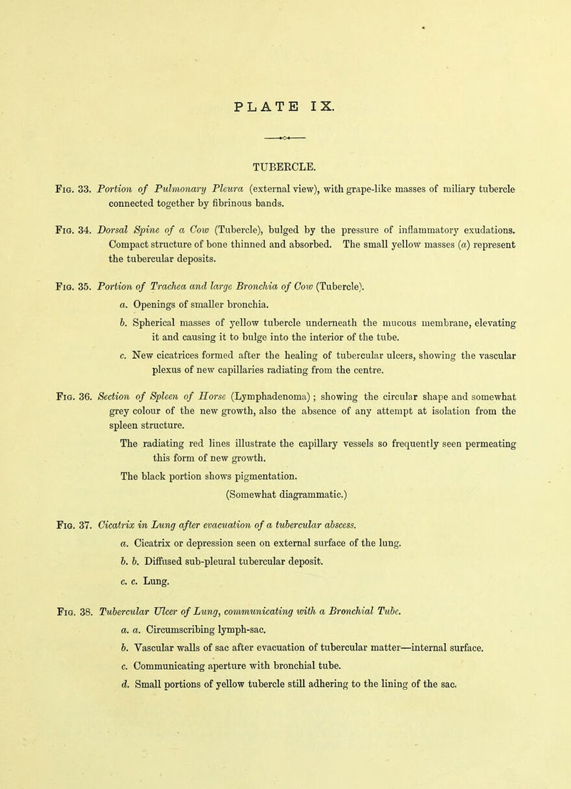 TUBERCLE. Fig. 33. Portion of Pulmonary Pleura (external view), with grape-like masses of miliary tubercle connected together by fibrinous bands. Fig. 34. Dorsal Spine of a Goiv (Tubercle), bulged by the pressure of inflammatory exudations. Compact structure of bone thinned and absorbed. The small yellow masses (a) represent the tubercular deposits. Fig. 35. Portion of Trachea and large Bronchia of Cow (Tubercle). a. Openings of smaller bronchia. b. Spherical masses of yellow tubercle underneath the mucous membrane, elevating it and causing it to bulge into the interior of the tube. c. New cicatrices formed after the healing of tubercular ulcers, showing the vascular plexus of new capillaries radiating from the centre. Fig. 36. Section of Spleen of Horse (Lymphadenoma); showing the circular shape and somewhat grey colour of the new growth, also the absence of any attempt at isolation from the spleen structure. The radiating red lines illustrate the capillary vessels so frequently seen permeating this form of new growth. The black portion shows pigmentation. (Somewhat diagrammatic.) Fig. 37. Cicatrix in Lung after evacuation of a tubercular abscess. a. Cicatrix or depression seen on external surface of the lung. b. b. Diifused sub-pleural tubercular deposit. c. c. Lung. Fig. 38. Tubercular Ulcer of Lung, convmunicating ivith a Bronchial Tube. a. a. Circumscribing lymph-sac. b. Vascular walls of sac after evacuation of tubercular matter—internal surface. c. Communicating aperture with bronchial tube. d. Small portions of yellow tubercle stUl adhering to the lining of the sac.