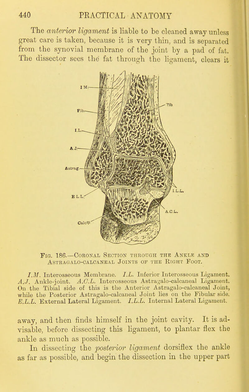 The anterior ligament is liable to be cleaned away unless great care is taken, because it is very thin, and is separated from the synovial membrane of the joint by a pad of fat. The dissector sees the fat through the ligament, clears it Fig. 186.—Ooromal Section through the Ankle and astragalo-calcaneal joints of 'j'he right foot. I.M. Interosseous Membrane. I.L. Inferior Interosseous Ligament, A.J. Ankle-joint. A.C.L. Interosseous Astra^'alo-calcaneal Ligament. On the Tibial side of this is the Anterior Astragalo-calcaneal Joint, while the Posterior Astragalo-calcaneal Joint lies on the Fibular side. E.L.L. External Lateral Ligament. I.L.L. Internal Lateral Ligament. away, and then finds himself in the joint cavity. It is ad- visable, before dissecting this ligament, to plantar flex the ankle as much as possible. In dissecting the posterior ligament dorsiflex the ankle as far as possible, and begin the dissection in the upper part