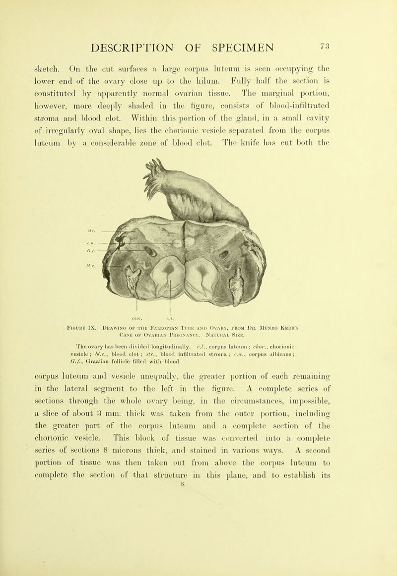 sketch. On the cut surfaces a large corpus luteum is seen occupying the lower end of the ovary close up to the hilum. Fully half the section is constituted by apparently normal ovarian tissue. The margiual portion, however, more deeply shaded in the figure, consists of blood-infiltrated stroma and l)lood clot. Within this portion of the gland, in a small cavity of irregularly oval shape, lies the chorionic vesicle separated from the corpus luteum by a consideralde zone of blood clot. The knife has cut both the ckor. c.l. Figure IX. Drawino of the Fallopian Tubh and Ovary, from Dk. MuNiio Kerr's Case of Ovarian' Pregnancy. Natural Size. The ovary lias been divided longitudinally. c.L, corpus luteum ; chor., chorionic vesicle; lil.c, blond clot; str., blood infiltrated stroma; c.a., corpus albicans; G.f., Graalian follicle filled with blood. corpus luteum and vesicle unequally, the greater portion of each remaining in the lateral segment to the left in the figure. A complete series of sections through the whole ovary being, in the circumstances, impossible, a slice of about 3 mm. thick was taken from the outer portion, including the greater part of the corpus luteum and a complete section of the chorionic vesicle. This block of tissue was converted into a complete series of sections 8 microns thick, and stained in various ways. A second portion of tissue was then taken out from above the corpus luteum to complete the section of that structure in this plane, and to establish its K