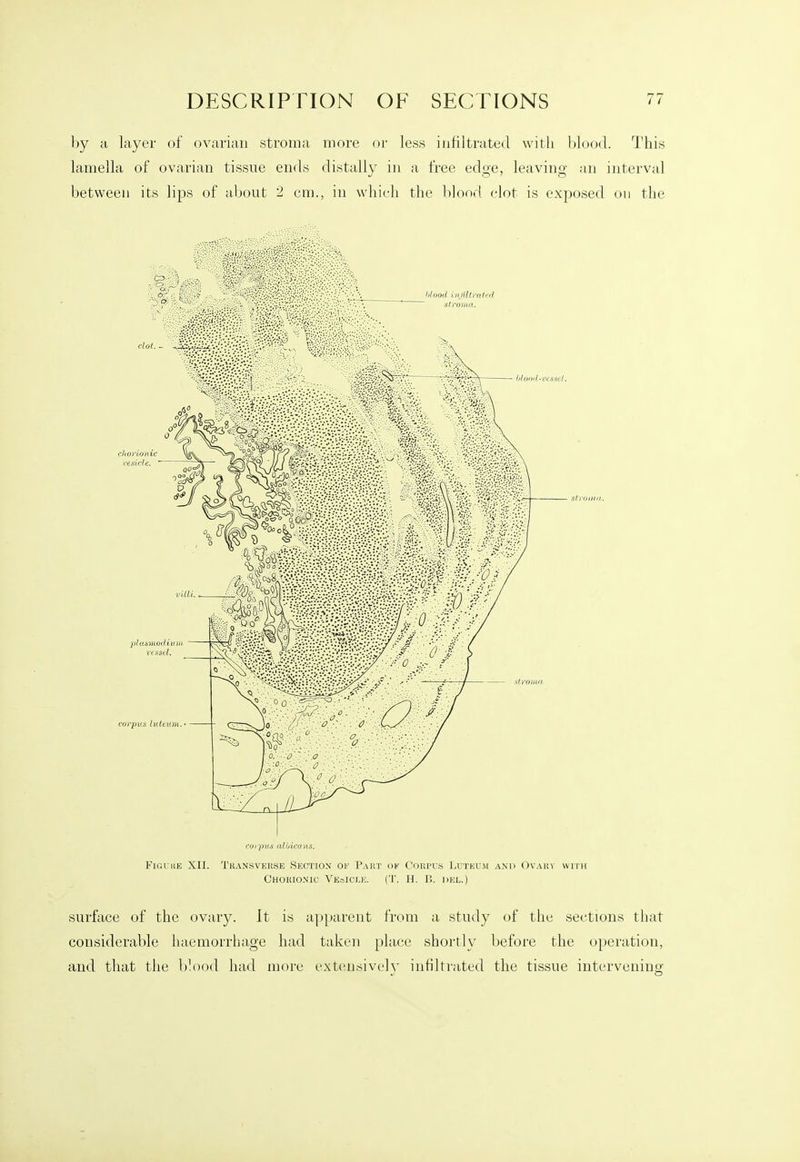 by a layer of ovarian stroma more or less infiltrated with blood. This lamella of ovarian tissue ends distally in a free edge, leaving ;i,n interval between its lips of about 2 cm., in which tiie blood clot is exposed on the surface of the ovary. It is apparent from a study of the sections that considerable iiaemorrhage had taken place shoi-tly before the operation, and that the b'ood had more cxtcnsivcl}' infiltrated the tissue intervening