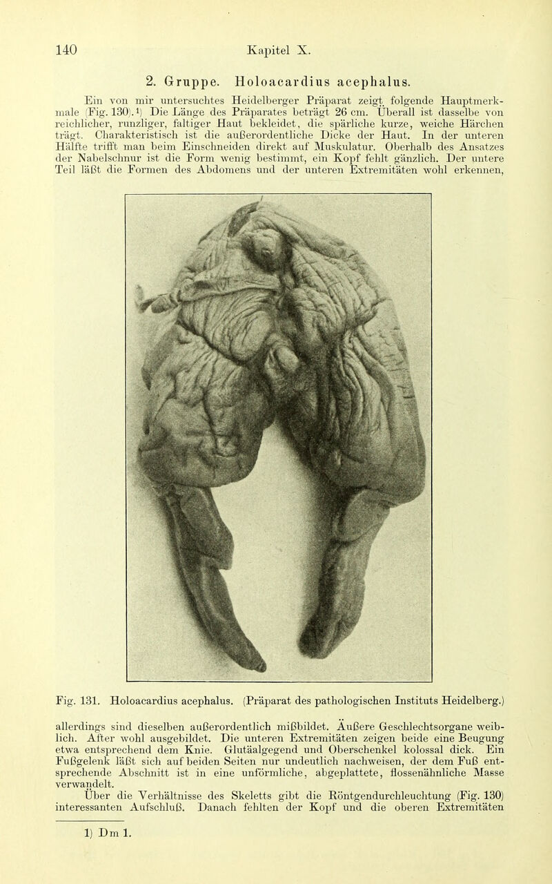 2. Gruppe. Holoacardius acephalus. Ein von mir untersuchtes Heidelberger Präparat zeigt folgende Hauptmerk- male (Fig. 130). 1) Die Länge des Präparates beträgt 26 cm. Überall ist dasselbe von reichlicher, runzliger, faltiger Haut bekleidet, die spärliche kurze, weiche Härchen ti'ägt. Charakteristisch ist die außerordentliche Dicke der Haut. In der untei'en Hälfte trifft man beim Einschneiden direkt auf Muskulatur. Oberhalb des Ansatzes der Nabelschnur ist die Form wenig bestimmt, ein Kopf fehlt gänzlich. Der untere Teil läßt die Formen des Abdomens und der untei'en Extremitäten wohl erkennen, Fig. 131. Holoacardius acephalus. (Präparat des pathologischen Instituts Heidelberg.) allerdings sind dieselben außerordentlich mißbildet. Außere Geschlechtsorgane weib- lich. After wohl ausgebildet. Die ixnteren Extremitäten zeigen beide eine Beugung etwa entsprechend dem Knie. Glutäalgegend und Oberschenkel kolossal dick. Ein Fußgelenk läßt sich auf beiden Seiten nur undeutlich nachweisen, der dem Fuß ent- sprechende Absclmitt ist in eine unförmliche, abgeplattete, flossenähnliche Masse verwandelt. Uber die Verhältnisse des Skeletts gibt die Röntgendurchleuchtung (Fig. 130) interessanten Aufschluß. Danach fehlten der Kopf und die oberen Extremitäten 1) Dm 1.