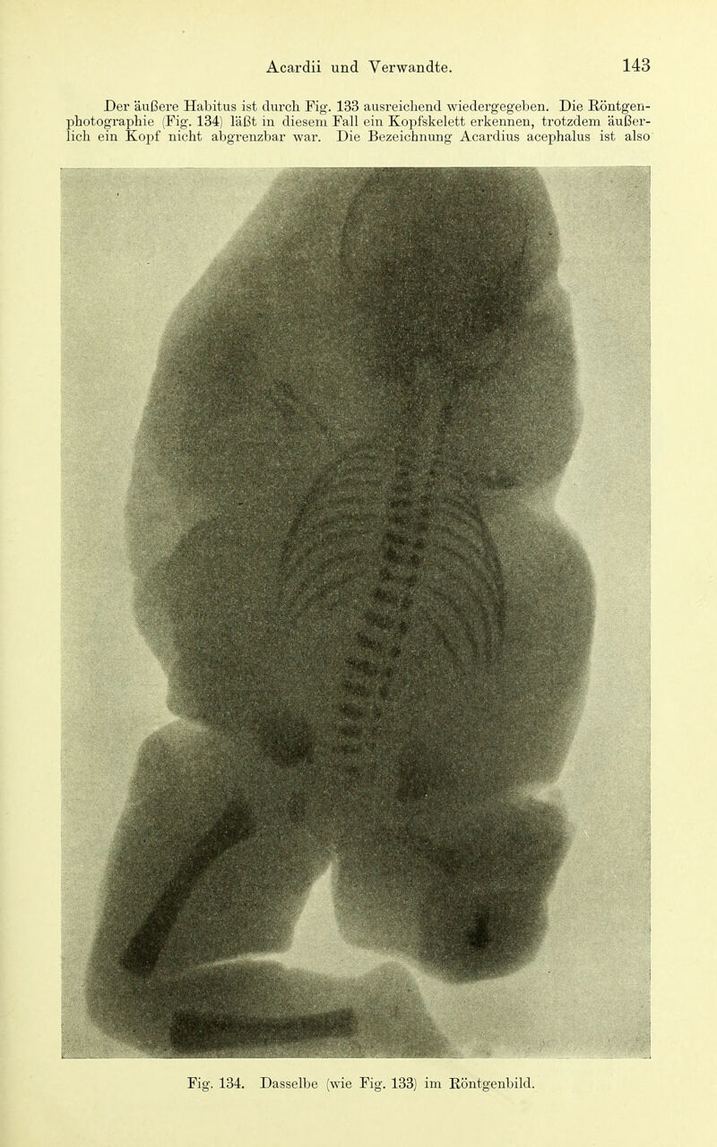 Der äußere Habitus ist durch Fig. 133 ausreicliend wiedergegeben. Die Röntgen- photograpbie (Fig. 134) läßt in diesem Fall ein Kopfskelett erkennen, trotzdem äußer- licli ein Kopf nicht abgrenzbar war. Die Bezeichnung Acardius acephalus ist also Fig. 134. Dasselbe (wie Fig. 133) im Röntgenbild.