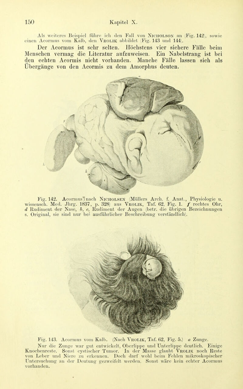 Als weiteres Beispiel führe ich den Fall von Nicholson an (Fig. 142), sowie einen Acormus vom Kalb, den Vrolik abbildet (Fig. 143 nnd 144). Der Acormus ist sehr selten. Höchstens vier sichere Fälle beim Menschen vermag die Literatur aufzuweisen. Ein Nabelstrang ist bei den echten Acormis nicht vorhanden. Manche Fälle lassen sich als Übergänge von den Acormis zu dem Amorphus deuten. r Fig. 142. Acorniuslnach Kiciiolsen (Müllers Arch. f. Anat., Physiologie u. wissensch. Med. Jhrg. 1837, p. 328) aus Vrolik, Taf. 62, Fig. 1. / rechtes Ohr, d Rudiment der Nase, 6, c, Rudiment der Augen (betr. die übrigen Bezeichnungen s. Original, sie sind nur bei ausführlicher Beschreibung verständlich). Fig. 143. Acormus vom Kall). (Nach Vrolik, Taf. 62, Fig. 5.) a Zunge. Nur die Zunge war gut entwickelt, Oberlippe und Unterlippe deutlich. Einige Knochenreste. Sonst cystischer T^imor. In der Masse glaubt Vrolik noch Reste von Leber imd Niere zu erkennen. Doch darf wohl beim Fehlen mikroskojjischer Untersuchung an der Deutung gezweifelt werden. Sonst wäre kein echter Acormus voi'handen.