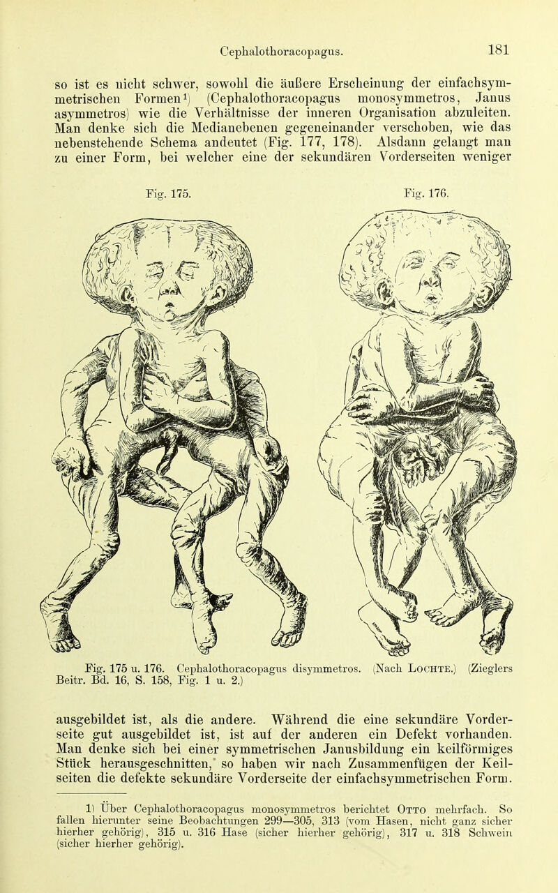 so ist es nicht schwer, sowohl die äußere Erscheinung der einfach sym- metrischen Formen ij (Cephalothoracopagus monosymmetros, Janus asymmetros) wie die Verhältnisse der inneren Organisation abzuleiten. Man denke sich die Medianebenen gegeneinander verschoben, wie das nebenstehende Schema andeutet (Fig. 177, 178). Alsdann gelangt man zu einer Form, bei welcher eine der sekundären Vorderseiten weniger Fig. 175. Fig. 176. Fig. 175 u. 176. Cephalothoracopagus disymmetros. (Nach Lochte.) (Zieglers Beitr. Bd. 16, S. 158, Fig. 1 u. 2.) ausgebildet ist, als die andere. Während die eine sekundäre Vorder- seite gut ausgebildet ist, ist auf der anderen ein Defekt vorhanden. Man denke sich bei einer symmetrischen Janusbildung ein keilförmiges Stück herausgeschnitten, so haben wir nach Zusammenfügen der Keil- seiten die defekte sekundäre Vorderseite der einfachsymmetrischen Form. 1) Über Cephalothoracopagus monosymmetros berichtet Otto mehrfach. So fallen hierunter seine Beobachtungen 299—305, 313 (vom Hasen, nicht ganz sicher hierher gehörig), 315 u. 316 Hase (sicher hierher gehörig), 317 u. 318 Schwein (sicher hierher gehörig).