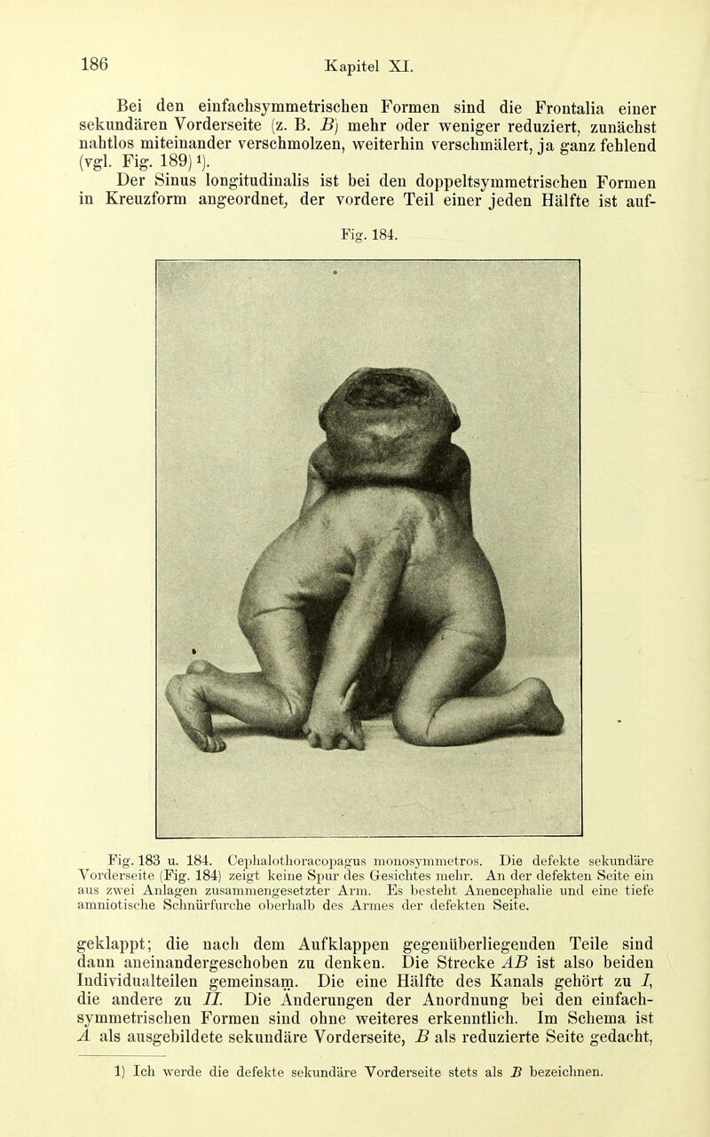 Bei den einfachsymmetrisclien Formen sind die Frontalia einer sekundären Vorderseite (z. B. B] mehr oder weniger reduziert, zunächst nahtlos miteinander verschmolzen, weiterhin verschmälert, ia ganz fehlend (vgl. Fig. 189)1). Der Sinus longitudinalis ist bei den doppeltsymraetrischen Formen in Kreuzform angeordnet^ der vordere Teil einer jeden Hälfte ist auf- Fig. 184. Fig. 183 u. 184. Ceplialütlioracopagus monosymmetros. Die defekte sekundäre Vorderseite (Fig. 184) zeigt keine Spur des Gesiclites mehr. An der defekten Seite ein aus zwei Anlagen zusammengesetzter Arm. Es besteht Anencephalie und eine tiefe amniotische Schnürfurche oberhalb des Armes der defekten Seite. geklappt; die nach dem Aufklappen gegenüberliegenden Teile sind dann aneinandergeschoben zu denken. Die Strecke AB ist also beiden Individualteilen gemeinsam. Die eine Hälfte des Kanals gehört zu /, die andere zu //. Die Änderungen der Anordnung bei den einfach- symmetrischen Formen sind ohne weiteres erkenntlich. Im Schema ist Ä als ausgebildete sekundäre Vorderseite, B als reduzierte Seite gedacht, 1) Ich werde die defekte sekundäre Vorderseite stets als S bezeichnen. i