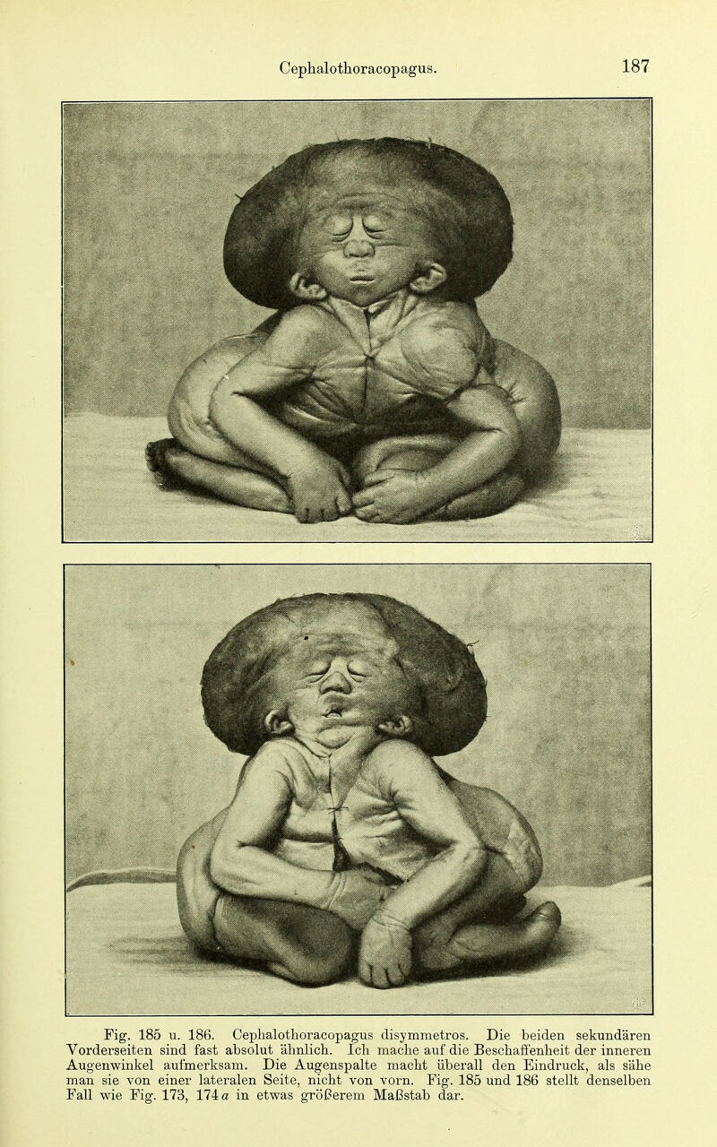 Fig. 185 u. 186. Cephalothoracopagus disymmetros. Die beiden sekundären Vorderseiten sind fast absolut ähnlich. Ich mache auf die Beschaffenheit der inneren Augenwinkel aufmerksam. Die Augenspalte macht überall den Eindruck, als sähe man sie von einer lateralen Seite, nicht von vorn. Fig. 185 und 186 stellt denselben Fall wie Fig. 173, 174 a in etwas größerem Maßstab dar.