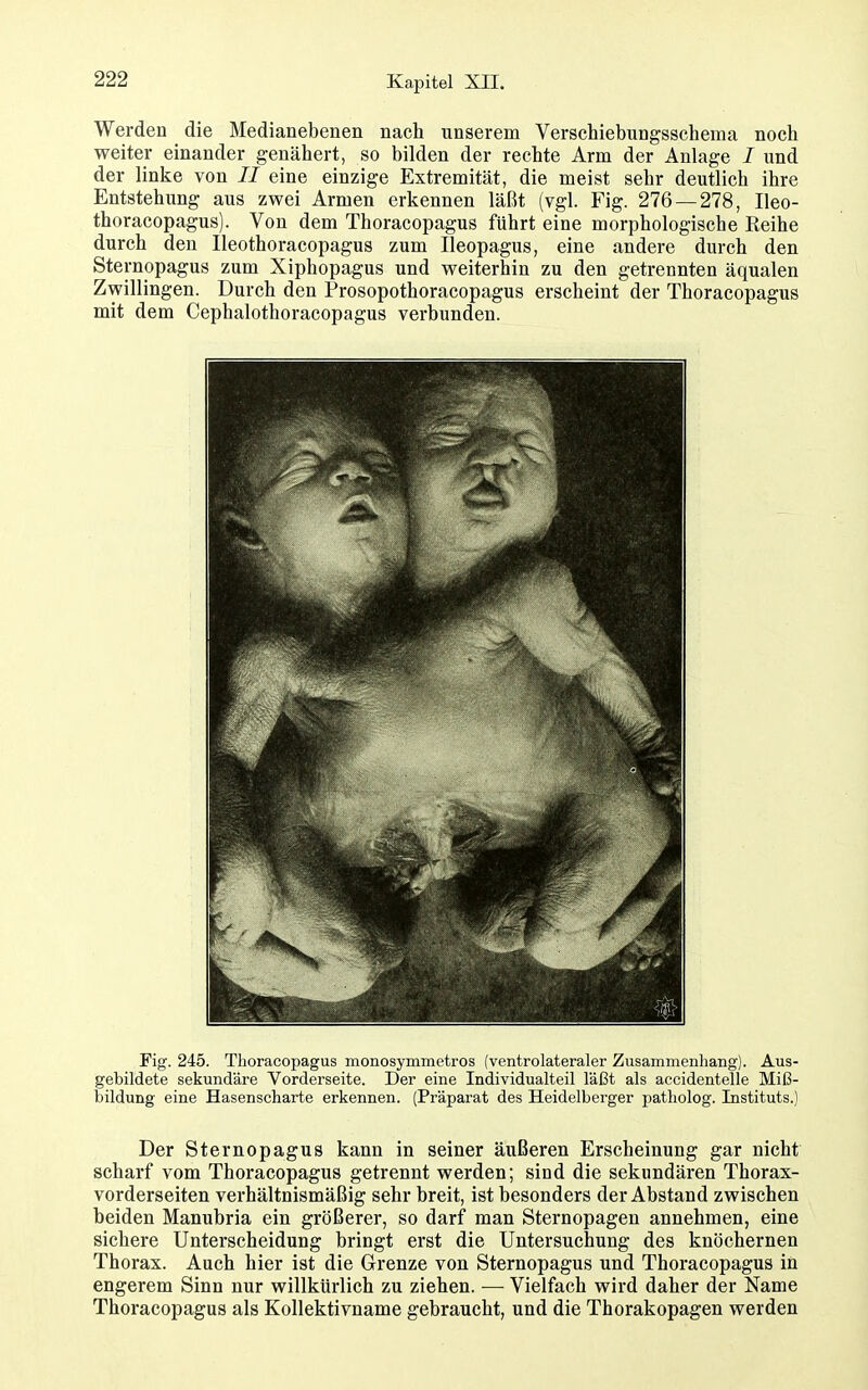 Werden die Medianebenen nach unserem Verschiebungsschema noch weiter einander genähert, so bilden der rechte Arm der Anlage / und der linke von II eine einzige Extremität, die meist sehr deutlich ihre Entstehung aus zwei Armen erkennen läßt (vgl. Fig. 276 — 278, Ileo- thoracopagus). Von dem Thoracopagus führt eine morphologische Reihe durch den Ileothoracopagus zum Ileopagus, eine andere durch den Sternopagus zum Xiphopagus und weiterhin zu den getrennten äqualen Zwillingen. Durch den Prosopothoracopagus erscheint der Thoracopagus mit dem Cephalothoracopagus verbunden. Fig. 245. Thoracopagus monosymmetros (ventrolateraler Zusammenhang). Aus- gebildete sekundäre Vorderseite. Der eine Individualteil läßt als accidentelle Miß- bildung eine Hasenscharte erkennen. (Präparat des Heidelberger patholog. Instituts.) Der Sternopagus kann in seiner äußeren Erscheinung gar nicht scharf vom Thoracopagus getrennt werden; sind die sekundären Thorax- vorderseiten verhältnismäßig sehr breit, ist besonders der Abstand zwischen beiden Manubria ein größerer, so darf man Sternopagen annehmen, eine sichere Unterscheidung bringt erst die Untersuchung des knöchernen Thorax. Auch hier ist die Grenze von Sternopagus und Thoracopagus in engerem Sinn nur willkürlich zu ziehen. — Vielfach wird daher der Name Thoracopagus als Kollektivname gebraucht, und die Thorakopagen werden