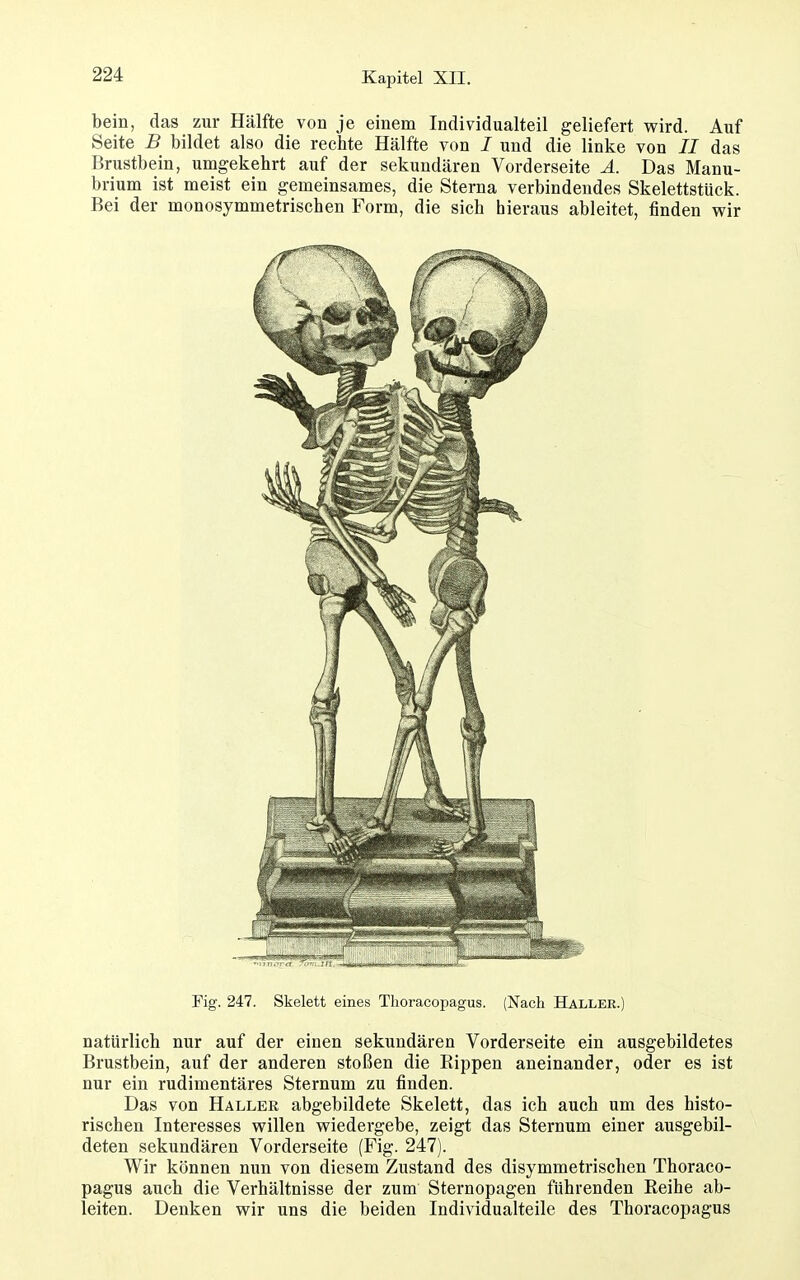 bein, das zur Hälfte von je einem Individualteil geliefert wird. Auf Seite B bildet also die rechte Hälfte von / und die linke von // das Brustbein, umgekehrt auf der sekundären Vorderseite Ä. Das Manu- brium ist meist ein gemeinsames, die Sterna verbindendes Skelettstück. Bei der monosymmetrischen Form, die sich hieraus ableitet, finden wir Fig. 247. Skelett eines Tlioracopagus. (Nach Haller.) natürlich nur auf der einen sekundären Vorderseite ein ausgebildetes Brustbein, auf der anderen stoßen die Rippen aneinander, oder es ist nur ein rudimentäres Sternum zu finden. Das von Haller abgebildete Skelett, das ich auch um des histo- rischen Interesses willen wiedergebe, zeigt das Sternum einer ausgebil- deten sekundären Vorderseite (Fig. 247). Wir können nun von diesem Zustand des disymmetrischen Thoraco- pagus auch die Verhältnisse der zum Sternopagen führenden Eeihe ab- leiten. Denken wir uns die beiden Individualteile des Thoracopagus