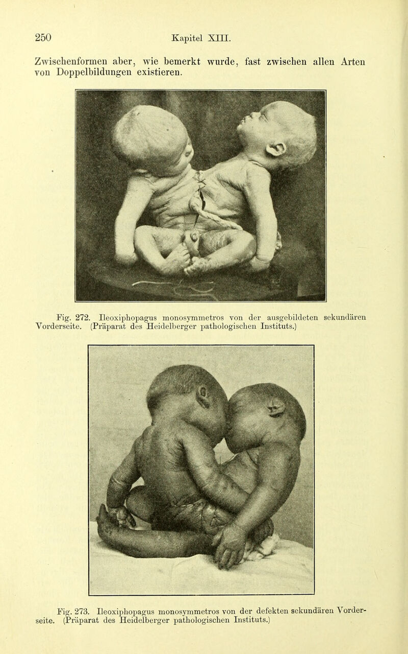 Zwischenformen aber, wie bemerkt wurde, fast zwischen allen Arten von Doppelbildungen existieren. Fig. 272. Ileoxiphopagus monosymmetros von der ausgebildeten sekundären Vorderseite. (Präparat des Heidelberger pathologischen Instituts.) Fig. 273. Ileoxiphopagus monosymmetros von der defekten sekundären Vorder- seite. (Präparat des Heidelberger pathologischen Instituts.)