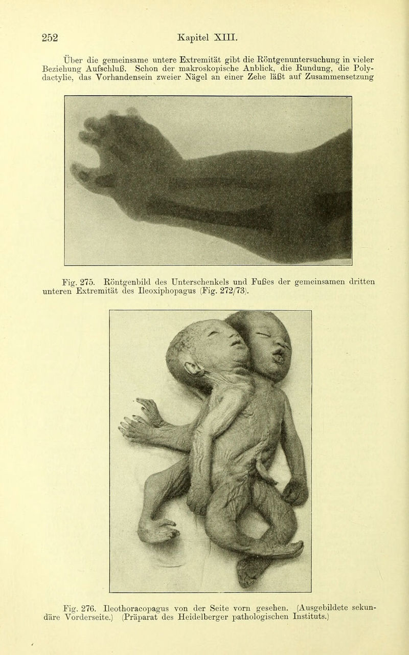 Über die gemeinsame untere Extremität gibt die Röntgenuntersuchung in vieler Beziehung Aufschluß. Schon der makroskopische Anblick, die Rundung, die Poly- dactylie, das Vorhandensein zweier Nägel an einer Zehe läßt auf Zusammensetzung Fig. 275. Röntgenbild des Unterschenkels und Fußes der gemeinsamen di'itten unteren Extremität des Ileoxiphopagus (Fig. 272/73). Fig. 276. Eeothoracopagus von der Seite vorn gesehen. (Ausgebildete sekun- däre Vorderseite.) (Präparat des Heidelberger pathologischen Instituts.)