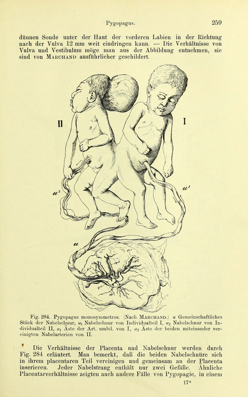 dünnen Sonde unter der Haut der vorderen Labien in der Richtung nach der Vulva 12 mm weit eindringen kann. — Die Verhältnisse von Vulva und Vestibulum möge man aus der Abbildung entnehmen, sie sind von Marchand ausführlicher geschildert. Fig. 284. Pygopagus monosymmetros. (Nach Marchand.) u Gemeinschaftliches Stück der Nabelschnur, mj Nabelschnur von Individualteil I, u-2 Nabelschnur von In- dividualteil II, «i Aste der Art. umbil. von I, «2 Aste der beiden miteinander ver- einigten Nabelarterien von II. ' Die Verhältnisse der Placenta und Nabelschnur werden durch Fig. 284 erläutert. Man bemerkt, daß die beiden Nabelschnüre sich in ihrem placentaren Teil vereinigen und gemeinsam an der Placenta inserieren. Jeder Nabelstrang enthält nur zwei Gretaße. Ähnliche Placentarverhältnisse zeigten auch andere Fälle von Pygopagie, in einem 17*