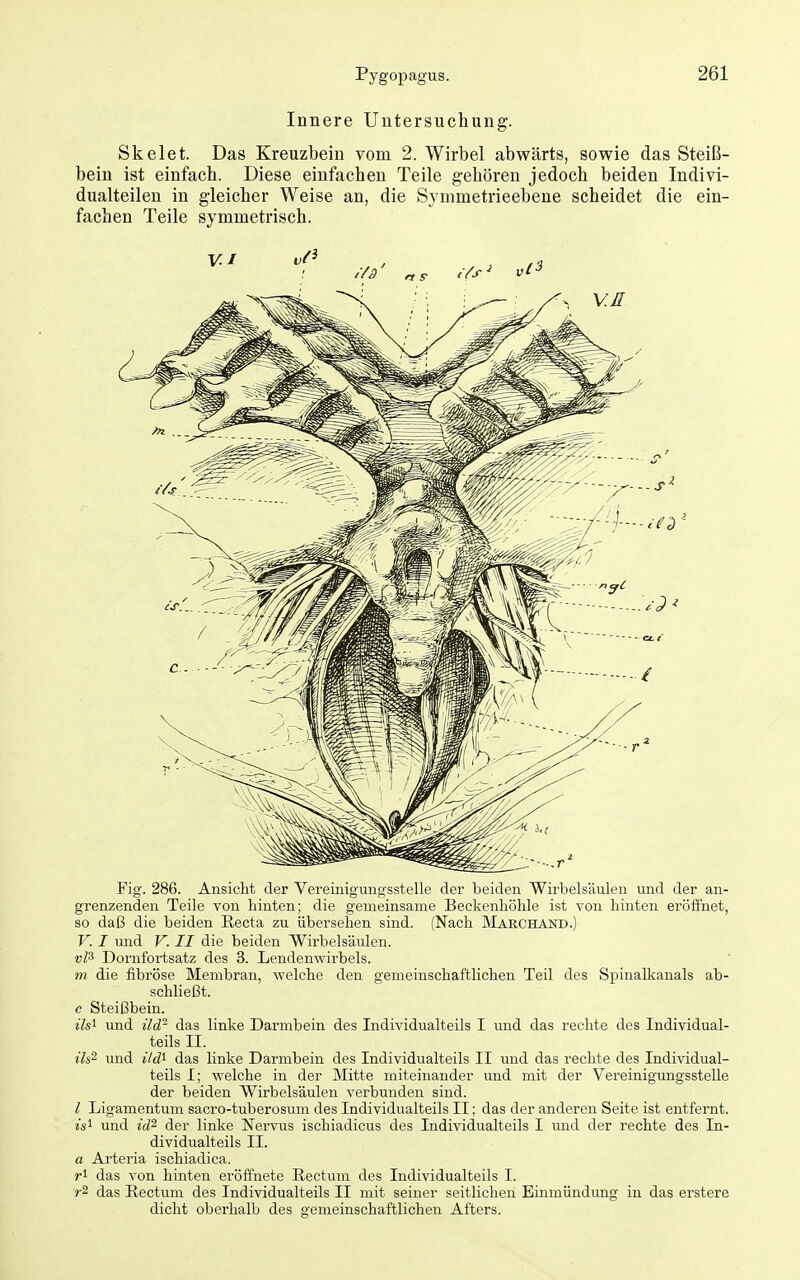 Innere Untersuchung. Skelet. Das Kreuzbein vom 2. Wirbel abwärts, sowie das Steiß- bein ist einfach. Diese einfachen Teile gehören jedoch beiden Indivi- dualteilen in gleicher Weise an, die Symmetrieebene scheidet die ein- fachen Teile symmetrisch. Fig. 286. Ansicht der Vereinigungsstelle der beiden Wirbelsäulen und der an- grenzenden Teile von hinten; die gemeinsame Beckenhöhle ist von hinten eröffnet, so daß die beiden Recta zu übersehen sind. (Nach MarchAND.) V. I und V. II die beiden Wirbelsäulen. Dornlbrtsatz des 3. Lendenwirbels. ni die fibröse Membran, vrelche den gemeinschaftlichen Teil des Spinalkanals ab- schließt. c Steißbein. ils^ und üd- das linke Darmbein des Individualteils I und das rechte des Individual- teils II. ils~ und jVtZi das linke Darmbein des Individualteils II und das rechte des Individual- teils I; welche in der Mitte miteinander und mit der Vereinigungsstelle der beiden AVirbelsäulen verbunden sind. l Ligamentum sacro-tuberosum des Individualteils II; das der anderen Seite ist entfernt. is^ und id^ der linke Nervus ischiadicus des Individualteils I und der rechte des In- dividualteils II. a Arteria ischiadica. das von hinten eröffnete Rectum des Individualteils I. das Rectum des Individualteils II mit seiner seitlichen Einmündung in das erstere dicht oberhalb des gemeinschaftlichen Afters.