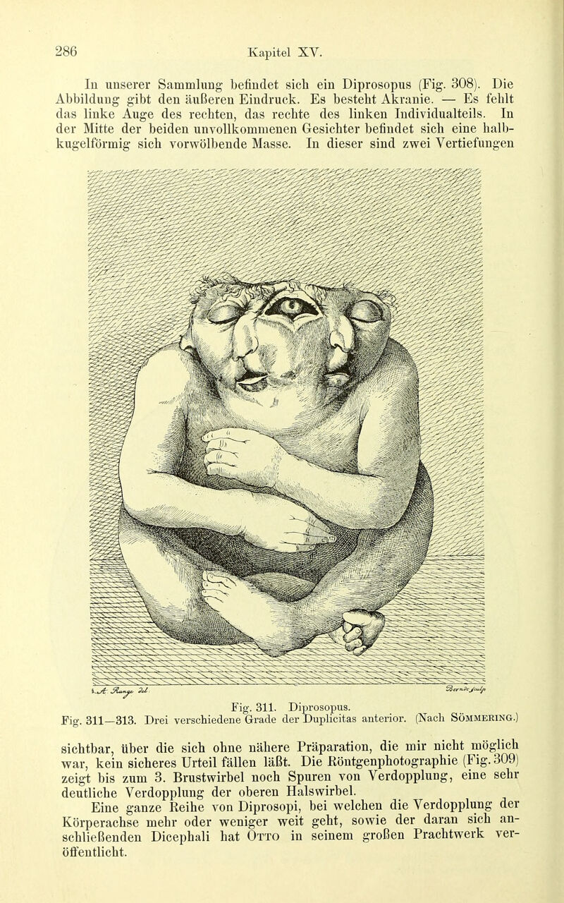 In unserer Sammlung befindet sich ein Diprosopus (Fig. 308). Die Abbildung gibt den äußeren Eindruck. Es besteht Akranie. — Es fehlt das linke Auge des rechten, das rechte des linken Individualteils. In der Mitte der beiden unvollkommenen Gesichter befindet sich eine halb- kugelförmig sich vorwölbende Masse. In dieser sind zwei Vertiefungen Fig. 311. Diprosopus. Fig. 311—313. Drei verschiedene Grade der Duplicitas anterior. (Nach Sömmering.) sichtbar, über die sich ohne nähere Präparation, die mir nicht möglich war, kein sicheres Urteil fällen läßt. Die Köntgenphotographie (Fig. 309) zeigt bis zum 3. Brustwirbel noch Spuren von Verdopplung, eine sehr deutliche Verdopplung der oberen Halswirbel. Eine ganze Reihe von Diprosopi, bei welchen die Verdopplung der Körperachse mehr oder weniger weit geht, sowie der daran sich an- schließenden Dicephali hat Otto in seinem großen Prachtwerk ver- öflentlicht.