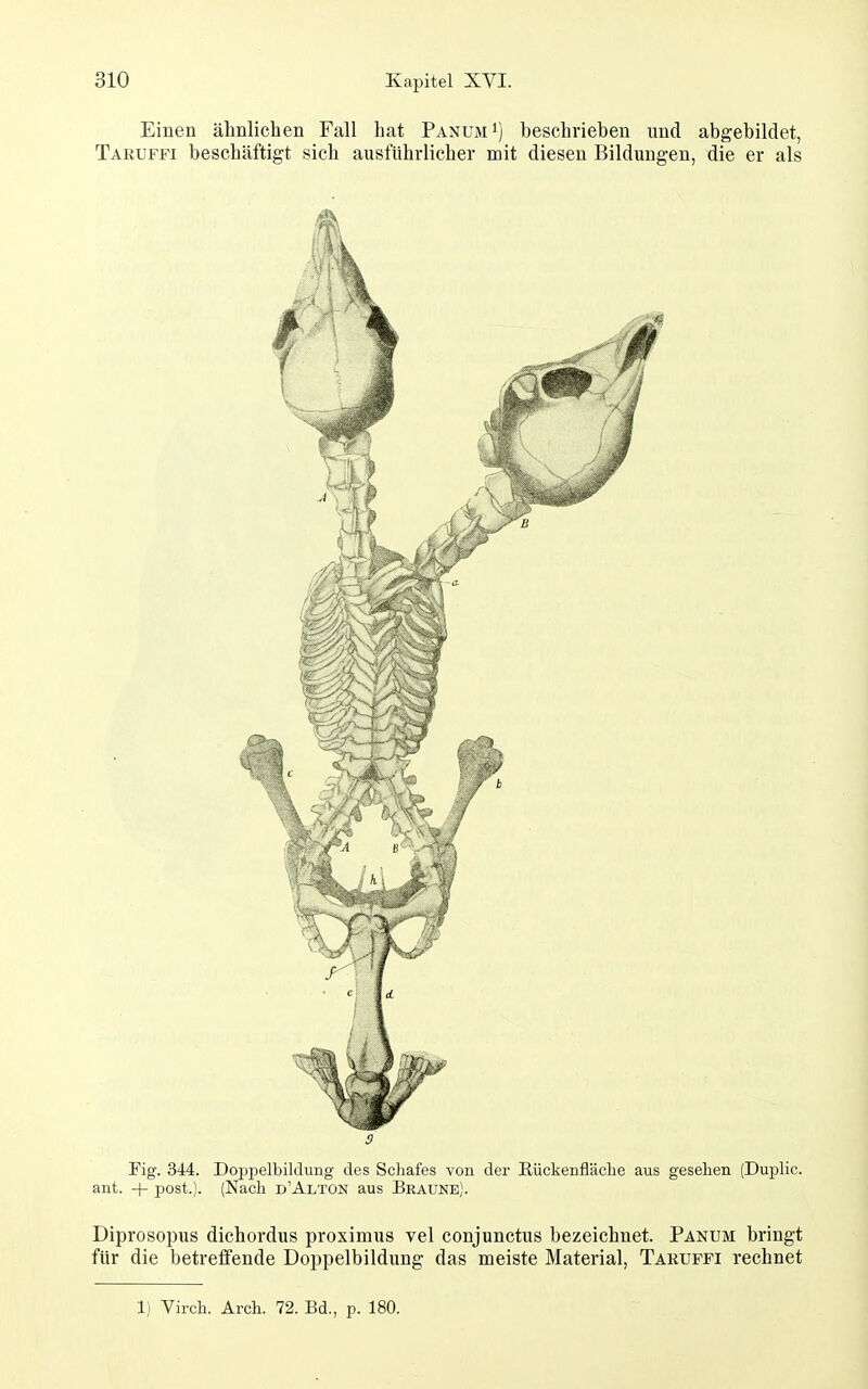 Einen ähnlichen Fall hat Panum^) beschrieben und abgebildet, Taruffi beschäftigt sich ausführlicher mit diesen Bildungen, die er als 3 Fig. 344. Doppelbildung des Scliafes von der Rückenfläche aus gesehen {Duplic. ant. + post). (Nach d'Alton aus Braune). Diprosopus dichordus proximus vel conjunctus bezeichnet. Panum bringt für die betreffende Doppelbildung das meiste Material, Takuffi rechnet 1) Virch. Arch. 72. Bd., p. 180.