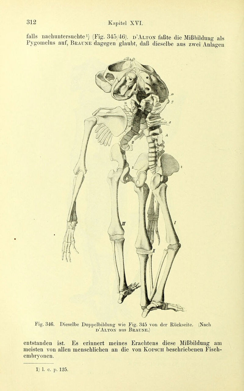 falls nachuntersuchtei) (Fig. 345/46). d'Alton faßte die Mißbildung- als Pygomelus auf, Braune dagegen glaubt, daß dieselbe aus zwei Anlagen Fig. 346. Dieselbe Doppelbildung wie Fig. 345 von der Rückseite. (Nach d'Alton aus Braune.) entstanden ist. Es erinnert meines Eraclitens diese Mißbildung am meisten von allen menschlichen an die von Kopsch beschriebenen Fisch- embryonen. 1) 1. c. p. 125.