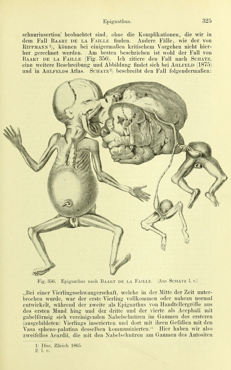 schnurinsertiou beobachtet sind, ohne die Komplikationen, die wir in dem Fall Baart de la Faille finden. Andere Fälle, wie der von Rippmann 1), können bei einigermaßen kritischem Vorgehen nicht hier- her gerechnet werden. Am besten beschrieben ist wohl der Fall von Baaut de LA Faille (Fig. 356). Ich zitiere den Fall nach Schatz, eine weitere Beschreibung und Abbildung findet sich bei Ahlfeld (1875) und in Ahlfelds Atlas. Schatz2) beschreibt den Fall folgendermaßen: Fig. 356. Epignathus nach Baart de la Faille. (Aus Schatz 1. c.) „Bei einer Vierlingsschwangerschaft, welche in der Mitte der Zeit unter- brochen wurde, war der erste Vierling vollkommen oder nahezu normal entwickelt, während der zweite als Epignathus von Handtellergroße aus des ersten Mund hing und der dritte und der vierte als Acephali mit gabelförmig sich vereinigenden Nabelschnüren im Gaumen des ersteren (ausgebildeten) Vierlings inserierten und dort mit ihren Gefäßen mit den Vasa spheno-palatina desselben kommunizierten. Hier haben wir also zweifellos Acardii, die mit den Nabelschnüren am Gaumen des Autositeu 1) Diss. Zürich 1865. 2) 1. c.