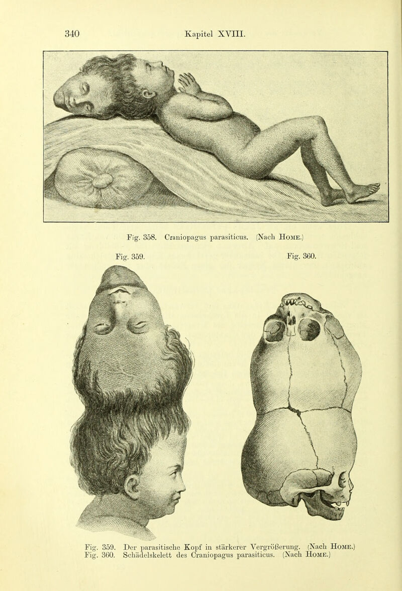 Fig. 358. Craniopagus parasiticus. (Nacli Home.) Fig. 359. Fig. 360. Fig. 359. Der parasitisclie Kopf in stärkerer Vergrößerung. (Nach Home.) Fig. 360. Scliäclelskelett des Craniopagus parasiticus. (Nach Home.)