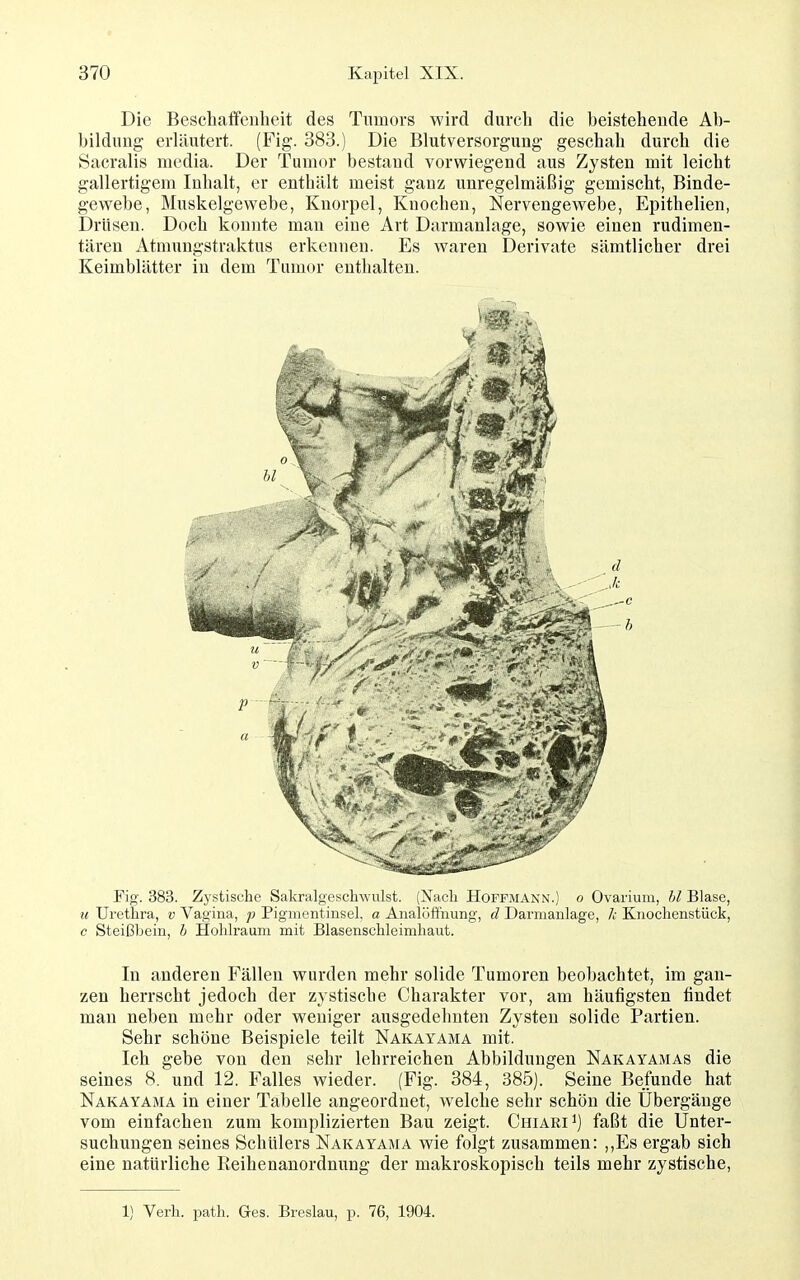 Die Beschaffenheit des Tumors wird durch die beistehende Ab- bildung erläutert. (Fig. 383.) Die Blutversorgung geschah durch die Sacralis media. Der Tumor bestand vorwiegend aus Zysten mit leicht gallertigem Inhalt, er enthält meist ganz unregelmäßig gemischt, Binde- gewebe, Muskelgewebe, Knorpel, Knochen, Nervengewebe, Epithelien, Drüsen. Doch konnte mau eine Art Darmanlage, sowie einen rudimen- tären Atmungstraktus erkennen. Es waren Derivate sämtlicher drei Keimblätter in dem Tumor enthalten. Fig. 383. Zystische Sakralgeschwulst. (Nach Hoffmann.) o Ovarium, bl Blase, t( Urethra, v Vagina, p Pigmentinsel, a Analüftnung, d Darmanlage, Je Knochenstück, c Steißbein, b Hohlraum mit Blasenschleimhaut. In anderen Fällen wurden mehr solide Tumoren beobachtet, im gan- zen herrscht jedoch der zystische Charakter vor, am häufigsten findet man neben mehr oder weniger ausgedehnten Zysten solide Partien. Sehr schöne Beispiele teilt Nakayama mit. Ich gebe von den sehr lehrreichen Abbildungen Nakayamas die seines 8. und 12. Falles wieder. (Fig. 384, 385). Seine Befunde hat Nakayama in einer Tabelle angeordnet, welche sehr schön die Übergänge vom einfachen zum komplizierten Bau zeigt. ChiariI) faßt die Unter- suchungen seines Schülers Nakayama wie folgt zusammen: ,,E8 ergab sich eine natürliche Reihenanordnung der makroskopisch teils mehr zystische. 1) Verh. path. Ges. Breslau, p. 76, 1904. .1