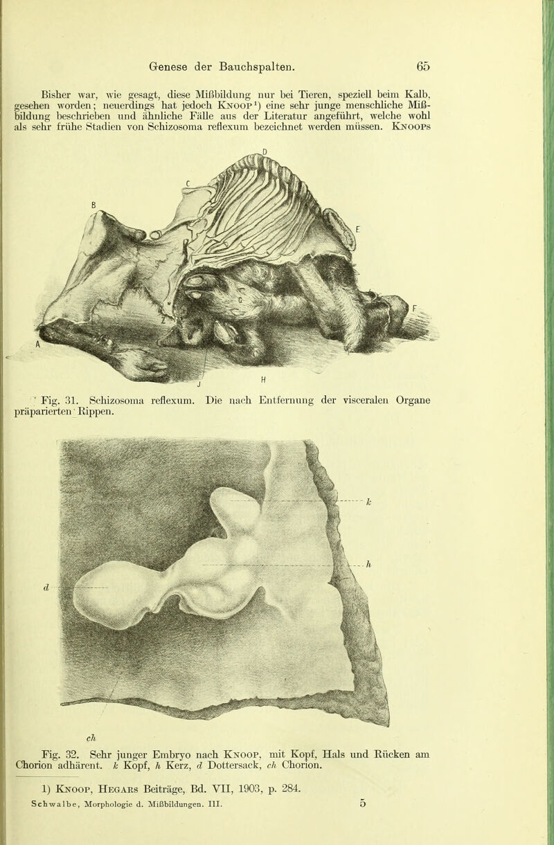 Bisher war, wie gesagt, diese Mißbildung nur bei Tieren, speziell beim Kalb, gesehen worden; neuerdings hat jedoch Knoop^) eine sehr junge menschhche Miß- bildung beschrieben und ähnUche Fälle aus der Literatur angeführt, welche wohl als sehr frühe Stadien von Schizosoma reflexum bezeichnet werden müssen. Knoops ' Fig. 31. Schizosoma reflexiim. Die nach Entfernung der visceralen Organe präparierten ■ Rippen. ch, Fig. 32. Sehr junger Embryo nach Knoop, mit Kopf, Hals und Rücken am Chorion adhärent. k Kopf, h Kerz, d Dottersack, ch Chorion. 1) Knoop, Hegars Beiträge, Bd. VII, 1903, p. 284. Schwalbe, Morphologie d. Mißbildungen. III. 5