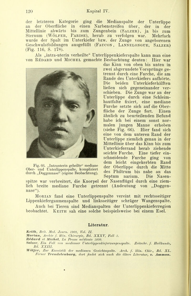 der letzteren Kategorie ging die Medianspalte der Unterlippe an der Oberfläche in einen Narbenstreifen über, der in der zum Zungenbein (Salzer) , ja bis zum bis Parise), herab zu verfolgen war. Mehrfach Unterkiefer bzw. der Zunge von angeborenen ausgefüllt (Faucon, Lannelongue, Salzer) Mittellinie abwärts Sternum (Wölfer, wurde der Spalt im Geschwulstbildungen (Fig. 116, S. 178). Als „intra-uterin verheilte Unterlippenkieferspalte kann man eine von Redard und Michel gemachte Beobachtung deuten: Hier war das Kinn von oben bis unten in zwei abgerundete Vorsprünge ge- trennt durch eine Furche, die am Rande des Unterkiefers aufhörte. Die beiden Unterkieferhälften ließen sich gegeneinander ver- schieben. Die Zunge war an der Unterlippe durch eine Schleim- hautfalte fixiert, eine mediane Furche setzte sich auf die Ober- fläche der Zunge fort. Einen ähnlich zu beurteilenden Befund habe ich bei einem sonst nor- malen jungen Manne erhoben (siehe Fig. 66). Hier fand sich eine von dem unteren Rand der Unterlippe ziemlich genau in der Mittellinie über das Kinn bis zum Unterkieferrand herab ziehende seichte Furche. Eine tiefer ein- schneidende Furche ging von dem leicht eingekerbten Rand der Oberlippe durch die Mitte des Philtrum bis nahe an das Septum narium. Die Nasen- spitze war verbreitert, die Knorpel der Nasenflügel durch eine ziem- lich breite mediane Furche getrennt (Andeutung von „Doggen- nase). MoRiAN fand eine Unterlippenspalte vereint mit rechtsseitiger Lippenkiefergaumenspalte und linksseitiger schräger Wangenspalte. Auch bei Tieren sind Medianspalten der Unterlippenkieferregion beobachtet. Keith sah eine solche beispielsweise bei einem Esel. Fig. 66. „Intrauterin geheilte mediane Ober- und ünterlippenspalte, kompliziert durch „Doggennase (eigene Beobachtung). Literatur. Keith, Brit. Med. Journ. 1909, Vol. II. Morian, Archiv f. klin. Chirurgie, Bd. XXXV, Fall 3. R4dard et Michel, la Presse medicale 1899. Salser, Ein Fall von media^ier Unterlippenkiejerzungenspalte. Zeitschr. f. Heilkicnde, Bd. XXIIL Wölfer, Zur Kasuistik der medianen Gesichtsspalte. Arch. f. klin. Chir., Bd. XL, Ferner Trendelenburg, dort findet sich auch die ältere Literatur, v. Amnion,