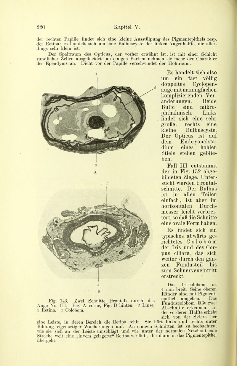 der rechten Papille findet sich eine kleine Ausstülpung des Pigmentepithels resp. der Eetina; es handelt sich um eine Bulbuscyste der linken Augenhälfte, die aller- dings sehr klein ist. Der Spaltraum des Opticus, der vorher erwähnt ist, ist mit einer Schicht rundhcher Zellen ausgeldeidet; an einigen Partien nehmen sie mehr den Charakter des Ependyms an. Dicht vor der Papille verschwindet der Hohlraum. Es handelt sich also um ein fast völlig doppeltes Cyclopen- auge mit mannigfachen komplizierenden Ver- änderungen. Beide Bulbi sind mikro- phthalmisch. Links findet sich eine sehr große, rechts eine kleine Bulbuscyste. Der Opticus ist auf dem Embryonalsta- dium eines hohlen Stiels stehen geblie- ben. Fall III entstammt der in Fig. 132 abge- bildeten Ziege. Unter- sucht wurden Frontal- schnitte. Der Bulbus ist in allen Teilen einfach, ist aber im horizontalen Durch- messer leicht verbrei- tert, so daß die Schnitte eine ovale Form haben. Es findet sich ein typisches abwärts ge- richtetes C 01 0 b 0 m der Iris und des Cor- pus ciliare, das sich weiter durch den gan- zen Fundusteil bis zum Sehnerveneintritt erstreckt. Das Iriscolobom ist 4 mm breit. Seine oberen Eänder sind mit Pigment- epithel umgeben. Das Funduscolobom läßt zwei Abschnitte erkennen. In der vorderen Hälfte erhebt sich von der Sklera her eine Leiste, in deren Bereich die Eetina fehlt. Sie hört Hnks und rechts unter Bildung eigenartiger Wucherungen auf. An einigen Schnitten ist zu beobachten, wie sie sich an der Leiste umschlägt und wie unter der normalen Netzhaut eine Strecke weit eine „invers gelagerte Eetina verläuft, die dann in das Pigmentepithel übergeht. Fig. Auge No, 2 Eetina. B 143. Zwei Schnitte (frontal) durch das III. Fig. A vorne, Fig. B hinten, l Linse. 3 Colobom.