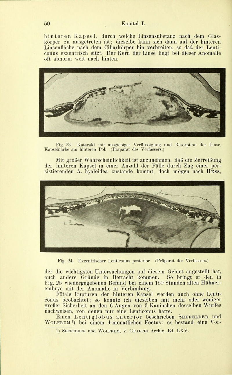 hinteren Kapsel, durch welche Linsensubstanz nach dem Glas- körper zu ausgetreten ist; dieselbe kann sich dann auf der hinteren Linsenfläche nach dem Ciliarkörper hin verbreiten, so daß der Lenti- conus exzentrisch sitzt. Der Kern der Linse liegt hei dieser Anomalie oft abnorm weit nach hinten. Fig. 23. Katarakt mit ausgiebiger Verflüssigung und Eesorption der Liiise, Kapselnarbe am hinteren Pol. (Präparat des Verfassers.) Mit großer Wahrscheinlichkeit ist anzunehmen, daß die Zerreißung der hinteren Kapsel in einer Anzahl der Fälle durch Zug einer per- sistierenden A. hyaloidea zustande kommt, doch mögen nach Hess, Fig. 24. Exzentrischer Lenticonus posterior. (Präparat des Verfassers.) der die wichtigsten Untersuchungen auf diesem Gebiet angestellt hat, auch andere Gründe in Betracht kommen. So bringt er den in Fig. 25 wiedergegebenen Befund bei einem 150 Stunden alten Hühner- embryo mit der Anomalie in Verbindung. Fötale Rupturen der hinteren Kapsel werden auch ohne Lenti- conus beobachtet; so konnte ich dieselben mit mehr oder weniger großer Sicherheit an den 6 Augen von 3 Kaninchen desselben Wurfes nachweisen, von denen nur eins Lenticonus hatte. Einen Lentiglobus anterior beschrieben Seefelder und Wolfrum i) bei einem 4-monatlichen Foetus: es bestand eine Vor- 1) Seefelder und Wolfbiim:, v. Geaefes Archiv, Bd. LXV.