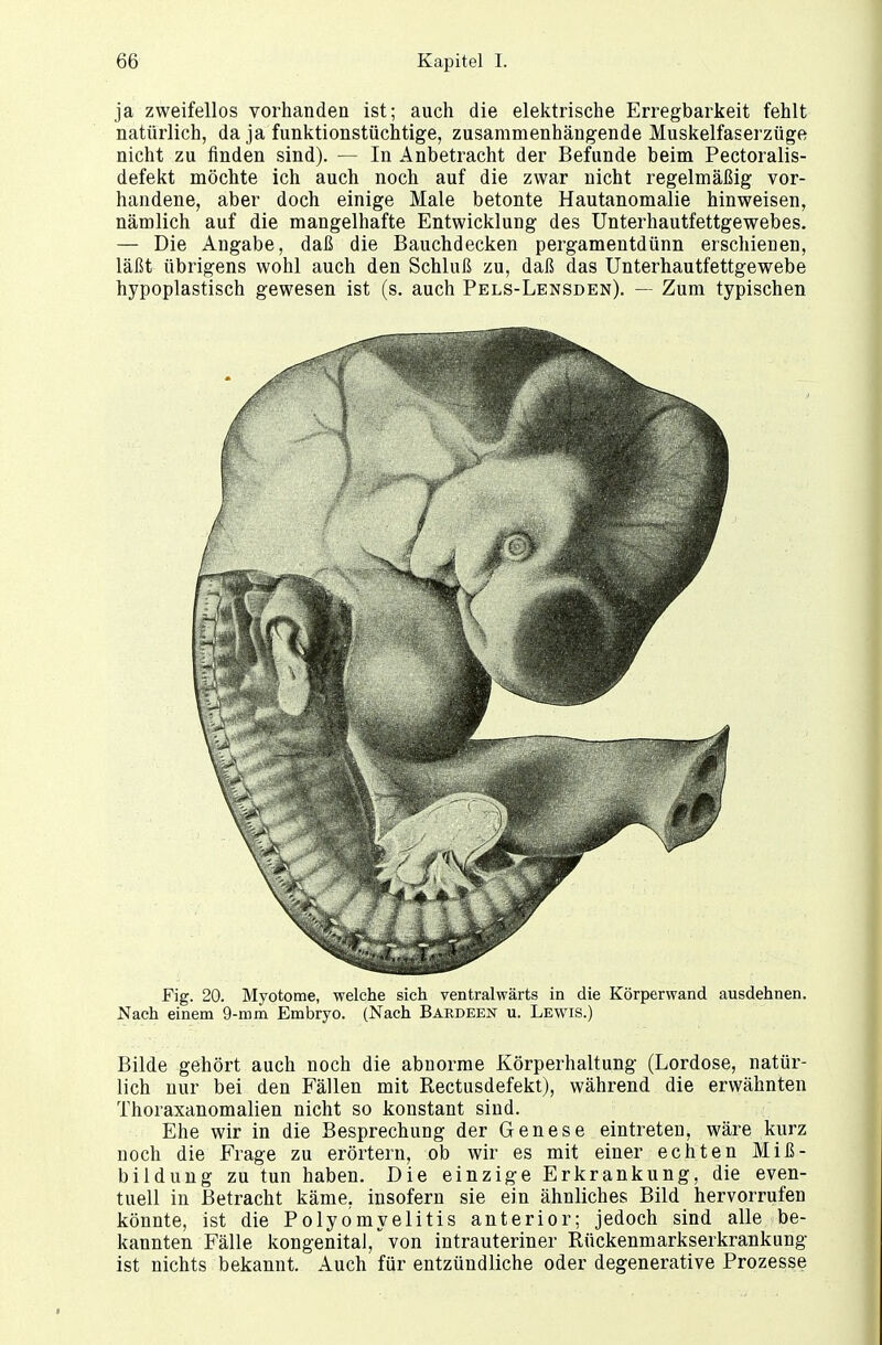 ja zweifellos vorhanden ist; auch die elektrische Erregbarkeit fehlt natürlich, da ja funktionstüchtige, zusammenhängende Muskelfaserzüge nicht zu finden sind). — In Anbetracht der Befunde beim Pectoralis- defekt möchte ich auch noch auf die zwar nicht regelmäßig vor- handene, aber doch einige Male betonte Hautanomalie hinweisen, nämlich auf die mangelhafte Entwicklung des Unterhautfettgewebes. — Die Angabe, daß die Bauchdecken pergamentdünn erschienen, läßt übrigens wohl auch den Schluß zu, daß das Unterhautfettgewebe hypoplastisch gewesen ist (s. auch Pels-Lensden). — Zum typischen Fig. 20. Myotome, welche sich ventralwärts in die Körperwand ausdehnen. Nach einem 9-mm Embryo. (Nach Bardeen u. Lewis.) Bilde gehört auch noch die abnorme Körperhaltung (Lordose, natür- lich nur bei den Fällen mit Rectusdefekt), während die erwähnten Thoraxanomalien nicht so konstant sind. Ehe wir in die Besprechung der Genese eintreten, wäre kurz noch die Frage zu erörtern, ob wir es mit einer echten Miß- bildung zu tun haben. Die einzige Erkrankung, die even- tuell in Betracht käme, insofern sie ein ähnliches Bild hervorrufen könnte, ist die Polyomyelitis anterior; jedoch sind alle be- kannten Fälle kongenital, von intrauteriner Rückenmarkserkrankung ist nichts bekannt. Auch für entzündliche oder degenerative Prozesse