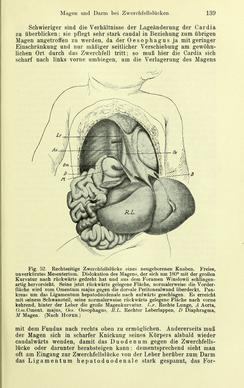 Schwieriger sind die Verhältnisse der Lageänderung der Cardia zu überblicken; sie pflegt sehr stark caudal in Beziehung zum übrigen Magen angetroffen zu werden, da der Oesophagus ja mit geringer Einschränkung und nur mäßiger seitlicher Verschiebung am gewöhn- lichen Ort durch das Zwerchfell tritt; so muß hier die Cardia sich scharf nach links vorne umbiegen, um die Verlagerung des Magens Fig. 52. Rechtseitige Zwerchfellslücke eines neugeborenen Knaben. Freies, unverkürztes Mesenterium. Dislokation des Magens, der sich um 180° mit der großen Kurvatur nach rückwärts gedreht hat und aus dem Foramen Winslowii schlingen- artig hervorsieht. Seine jetzt rückwärts gelegene Fläche, normalerweise die Vorder- fläche wird vom Omentum majus gegen die dorsale Peritonealwand überdeckt. Pan- kreas um das Ligamentum hepatoduodenale nach aufwärts geschlagen. Es erreicht mit seinem Schwanzteil, seine normalerweise rückwärts gelegene Fläche nach vorne kehrend, hinter der Leber die große Magenkurvatur. L.r. Rechte Lunge, A Aorta, O.m.Oment. majus, Oes. Oesophagus, R.L. Rechter Leberlappen, D Diaphragma, M Magen. (Nach Hofer.) mit dem Fundus nach rechts oben zu ermöglichen. Andererseits muß der Magen sich in scharfer Knickung seines Körpers alsbald wieder caudalwärts wenden, damit das Duodenum gegen die Zwerchfells- lücke oder darunter herabsteigen kann; dementsprechend sieht man oft am Eingang zur Zwerchfellslücke von der Leber herüber zum Darm das Ligamentum hepatoduodenale stark gespannt, das For-