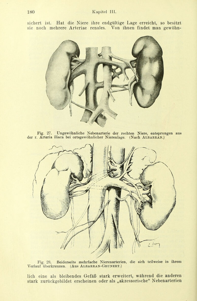 sichert ist. Hat die Niere ihre endgültige Lage erreicht, so besitzt sie noch mehrere Arteriae renales. Von ihnen findet man gewöhn- Fig. 28. Beiderseits mehrfache Nierenarterien, die sich teilweise in ihrem Verlauf überkreuzen. (Aus Albarran-Grunert.) lieh eine als bleibendes Gefäß stark erweitert, während die anderen stark zurückgebildet erscheinen oder als „akzessorische Nebenarterien