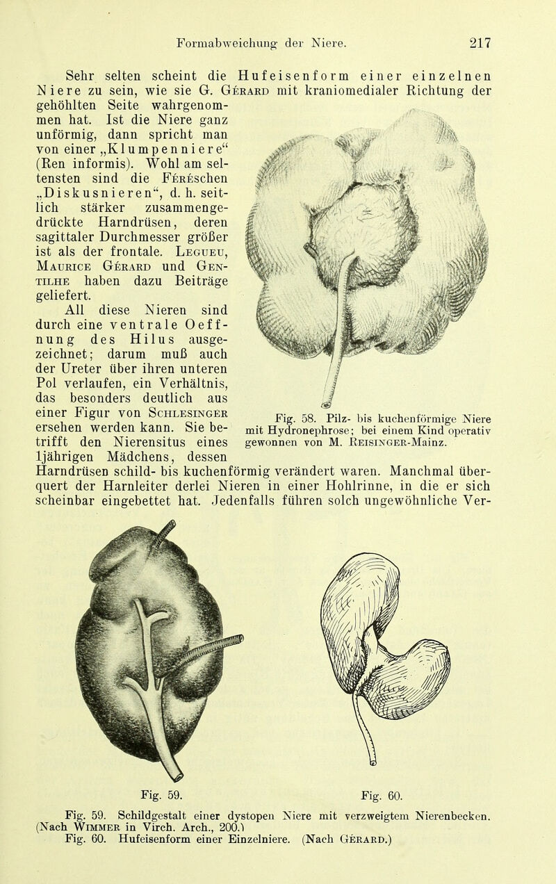 Sehr selten scheint die Hufeisenform einer einzelnen Niere zu sein, wie sie G. Geeaed mit kraniomedialer Richtung der gehöhlten Seite wahrgenom- I men hat. Ist die Niere ganz unförmig, dann spricht man von einer „K1 u m p e n n i e r e (Ren informis). Wohl am sel- tensten sind die FERESchen ..Diskusnieren, d.h. seit- lich stärker zusammenge- drückte Harndrüsen, deren sagittaler Durchmesser größer ist als der frontale. Legueu, Maueice Geeaed und Gen- tilhe haben dazu Beiträge geliefert. All diese Nieren sind durch eine ventrale Oeff- nung des Hilus ausge- zeichnet; darum muß auch der Ureter über ihren unteren Pol verlaufen, ein Verhältnis, das besonders deutlich aus einer Figur von Schlesingee ersehen werden kann. Sie be- trifft den Nierensitus eines ljährigen Mädchens, dessen Harndrüsen schild- bis kuchenförmig verändert waren. Manchmal über- quert der Harnleiter derlei Nieren in einer Hohlrinne, in die er sich scheinbar eingebettet hat. Jedenfalls führen solch ungewöhnliche Ver- Fig. 58. Pilz- bis kuchenförmige Niere mit Hydronephrose; bei einem Kind operativ gewonnen von M. BEISESTGER-Mainz. Fig. 59. Fig. 60. Fig. 59. Schildgestalt einer dystopen Niere mit verzweigtem Nierenbecken. (Nach Wimmer in Virch. Arch., 200.1 Fig. 60. Hufeisenform einer Einzelniere. (Nach Gerard.)