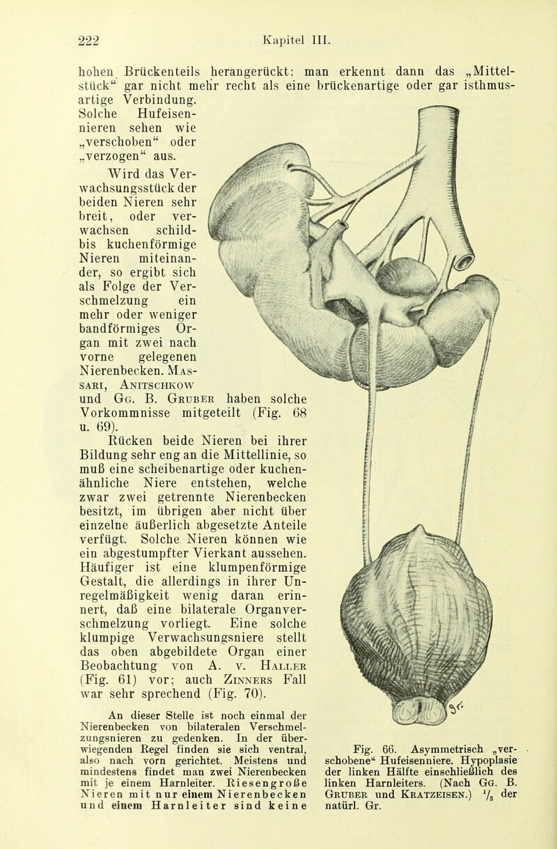 hohen Brückenteils herangerückt: man erkennt dann das „Mittel- stück gar nicht mehr recht als eine brückenartige oder gar isthmus- artige Verbindung. Solche Hufeisen- nieren sehen wie „verschoben oder ..verzogen aus. Wird das Ver- wachsungsstück der beiden Nieren sehr breit, oder ver- wachsen schild- bis kuchenförmige Nieren miteinan- der, so ergibt sich als Folge der Ver- schmelzung ein mehr oder weniger bandförmiges Or- gan mit zwei nach vorne gelegenen Nierenbecken. Mas- sari, Anitschkow und Gg. B. Gruber haben solche Vorkommnisse mitgeteilt (Fig. 68 u. 69). Rücken beide Nieren bei ihrer Bildung sehr eng an die Mittellinie, so muß eine scheibenartige oder kuchen- ähnliche Niere entstehen, welche zwar zwei getrennte Nierenbecken besitzt, im übrigen aber nicht über einzelne äußerlich abgesetzte Anteile verfügt. Solche Nieren können wie ein abgestumpfter Vierkant aussehen. Häufiger ist eine klumpenförmige Gestalt, die allerdings in ihrer Un- regelmäßigkeit wenig daran erin- nert, daß eine bilaterale Organver- schmelzung vorliegt. Eine solche klumpige Verwachsungsniere stellt das oben abgebildete Organ einer Beobachtung von A. v. Haller (Fig. 61) vor; auch Zinners Fall war sehr sprechend (Fig. 70). An dieser Stelle ist noch einmal der Nierenbecken von bilateralen Verschmel- zungsnieren zu gedenken. In der über- wiegenden Regel finden sie sich ventral, also nach vorn gerichtet. Meistens und mindestens findet man zwei Nierenbecken mit je einem Harnleiter. Riesengroße Nieren mit nur einem Nierenbecken und einem Harnleiter sind keine Fig. 66. Asymmetrisch „ver- schobene Hufeisenniere. Hypoplasie der linken Hälfte einschließlich des linken Harnleiters. (Nach Gg. ß. Gruber und Kratzeisen.) '/s der natürl. Gr.
