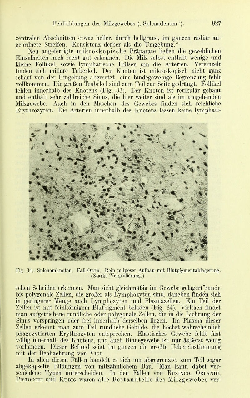 zentralen Abschnitten etwas heller, durch hellgraue, im ganzen radiär an- geordnete Streifen. Konsistenz derber als die Umgebung. Neu angefertigte mikroskopische Präparate ließen die geweblichen Einzelheiten noch recht gut erkennen. Die Milz selbst enthält wenige und kleine Follikel, sowie lymphatische Hülsen um die Arterien. Vereinzelt finden sich miliare Tuberkel. Der Knoten ist mikroskopisch nicht ganz scharf von der Umgebung abgesetzt, eine bindegewebige Begrenzung fehlt vollkommen. Die großen Trabekel sind zum Teil zur Seite gedrängt. Follikel fehlen innerhalb des Knotens (Fig. 33). Der Knoten ist retikulär gebaut und enthält sehr zahlreiche Sinus, die hier weiter sind als im umgebenden Milzgewebe. Auch in den Maschen des Gewebes finden sich reichliche Erythrozyten. Die Arterien innerhalb des Knotens lassen keine lymphati- I * t I vi ■ 4 • * * tr .T Ä. Vi» * Vi * * ^ #: . .,*v •> A ... ... Fig. 34. Spienomknoten. Fall Orth. Rein pulpöser Aufbau mit Blutpigmentablagerung. (Starke Vergrößerung.) sehen Scheiden erkennen. Man sieht gleichmäßig im Gewebe gelagert'runde bis polygonale Zellen, die größer als Lymphozyten sind, daneben finden sich in geringerer Menge auch Lymphozyten und Plasmazellen. Ein Teil der Zellen ist mit feinkörnigem Blutpigment beladen (Fig. 34). Vielfach findet man aufgetriebene rundliche oder polygonale Zellen, die in die Lichtung der Sinus vorspringen oder frei innerhalb derselben liegen. Im Plasma dieser Zellen erkennt man zum Teil rundliche Gebilde, die höchst wahrscheinlich phagozytierten Erythrozyten entsprechen. Elastisches Gewebe fehlt fast völlig innerhalb des Knotens, und auch Bindegewebe ist nur äußerst wenig vorhanden. Dieser Befund zeigt im ganzen die größte Uebereinstimmung mit der Beobachtung von Vigi. In allen diesen Fällen handelt es sich um abgegrenzte, zum Teil sogar abgekapselte Bildungen von milzähnlichem Bau. Man kann dabei ver- schiedene Typen unterscheiden. In den Fällen von Businco, Orlandi, Pistocchi und Kubig waren alle Bestandteile des Milzgewebes ver-